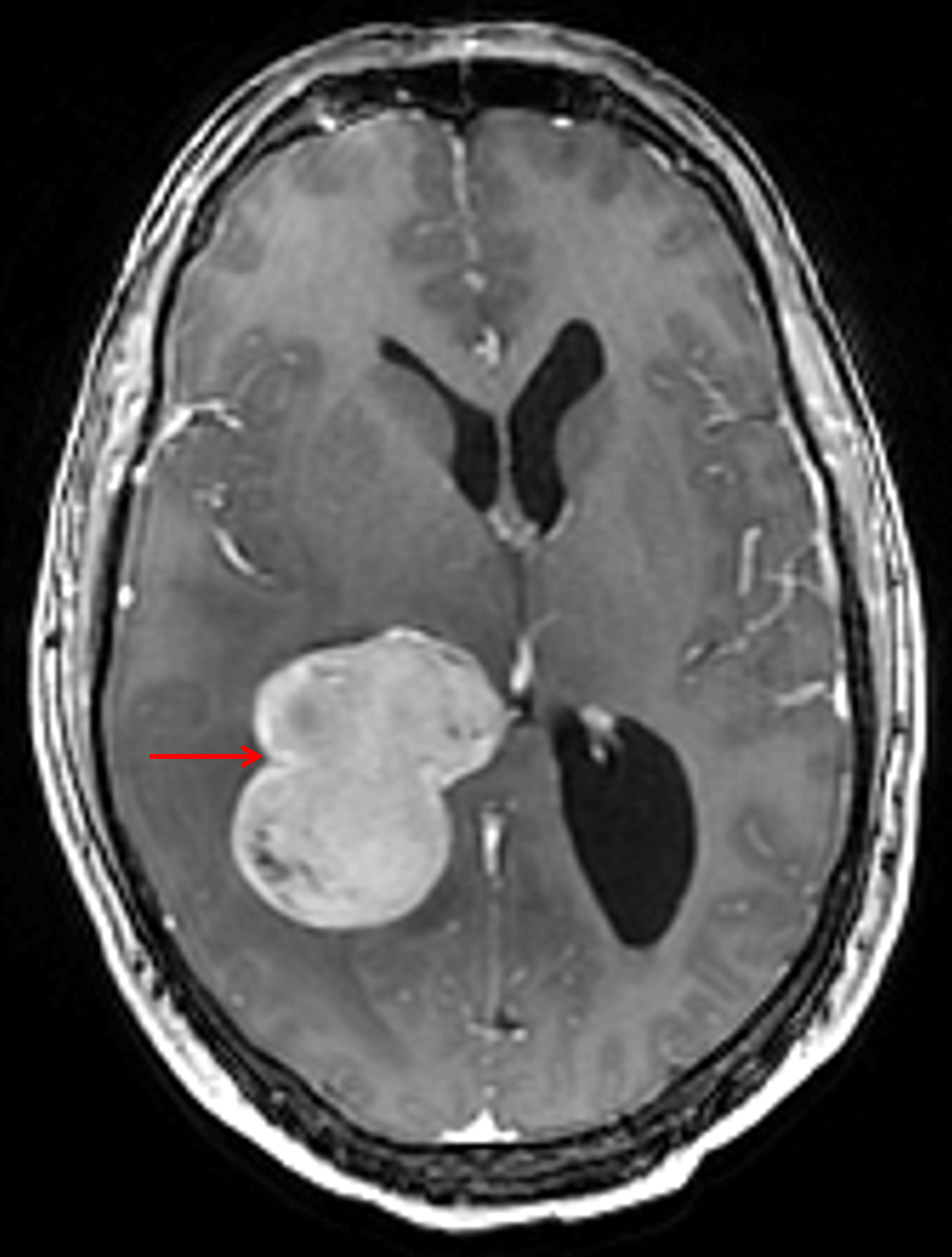 Homogeneously enhancing mass centered in the atrium of the right lateral ventricle (red arrow).