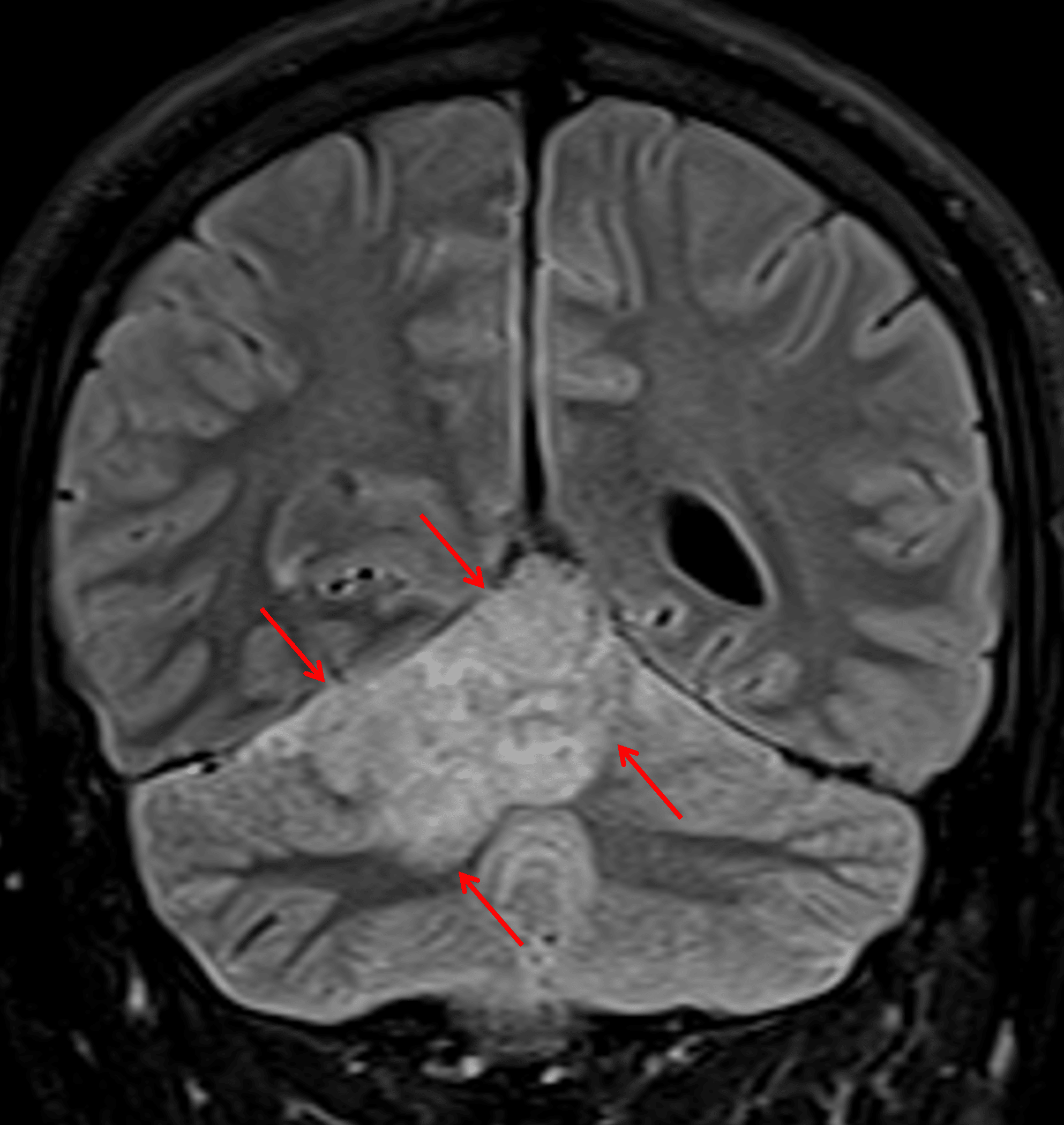 T2/FLAIR hyperintense mass in the superior aspect of the right cerebellar hemisphere and vermis (red arrows).