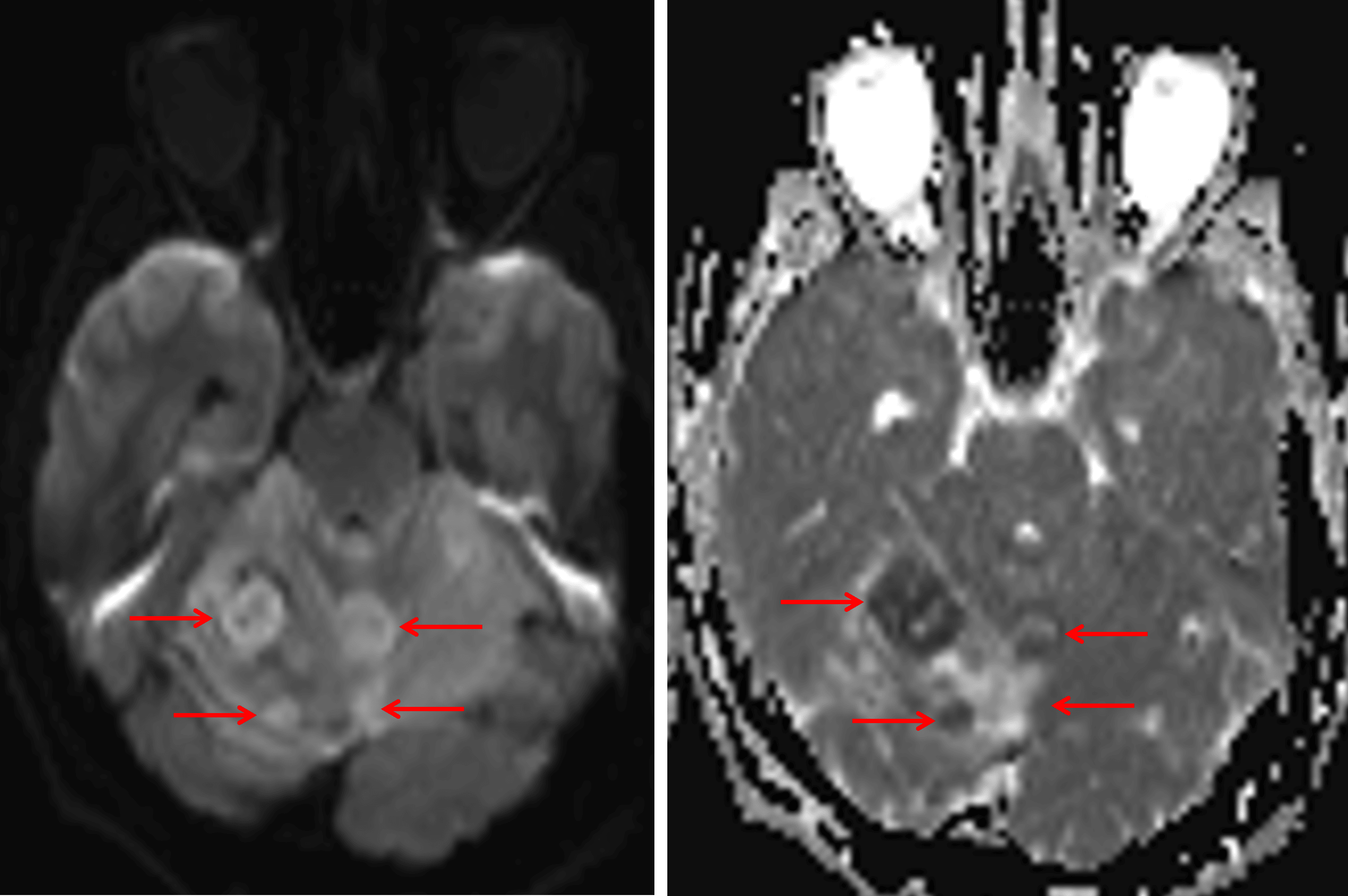 Internal nodular areas of restricted diffusion (red arrows).