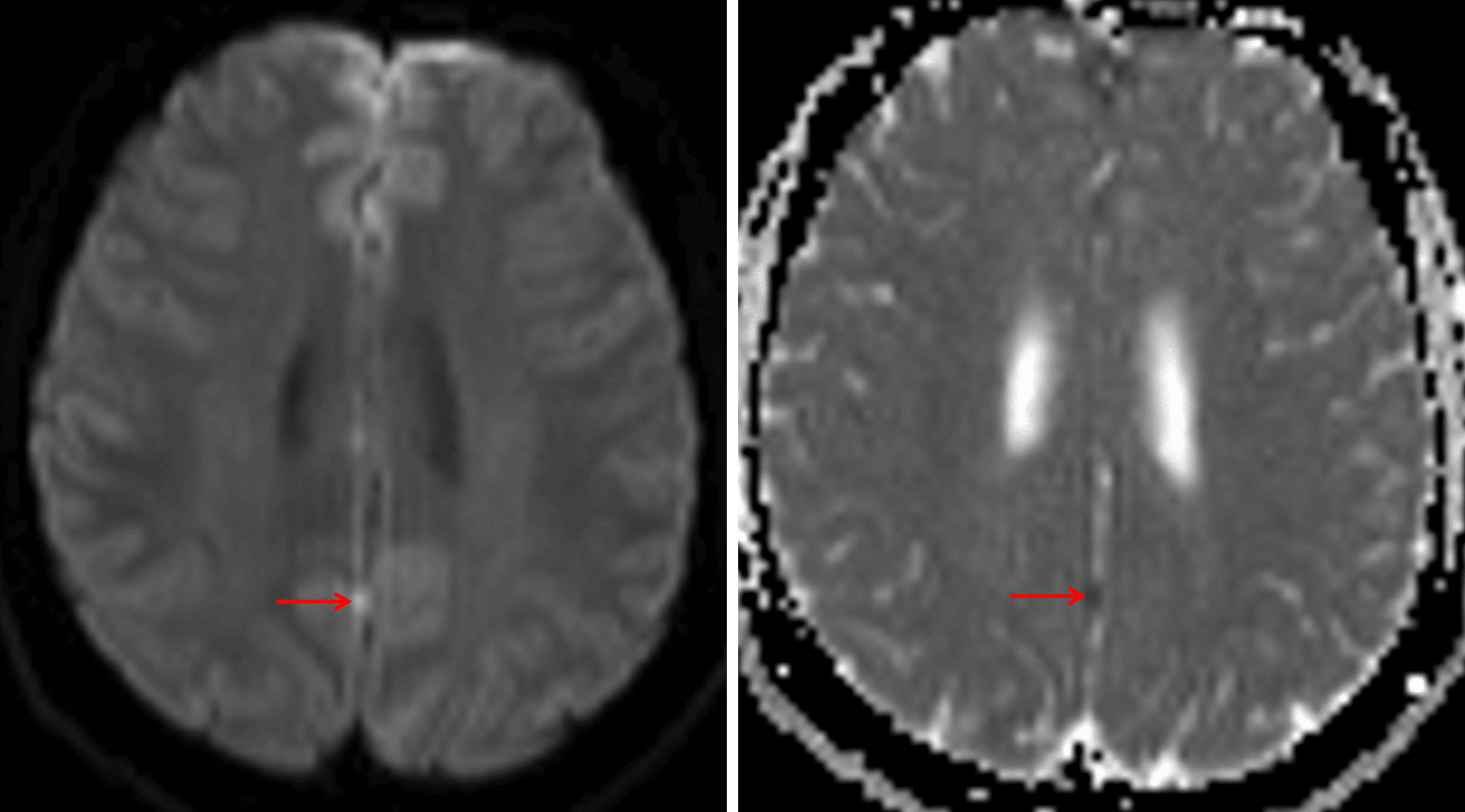 Nodular focus of restricted diffusion along the interhemispheric fissure (red arrows), which is concerning for a leptomeningeal tumor deposit.