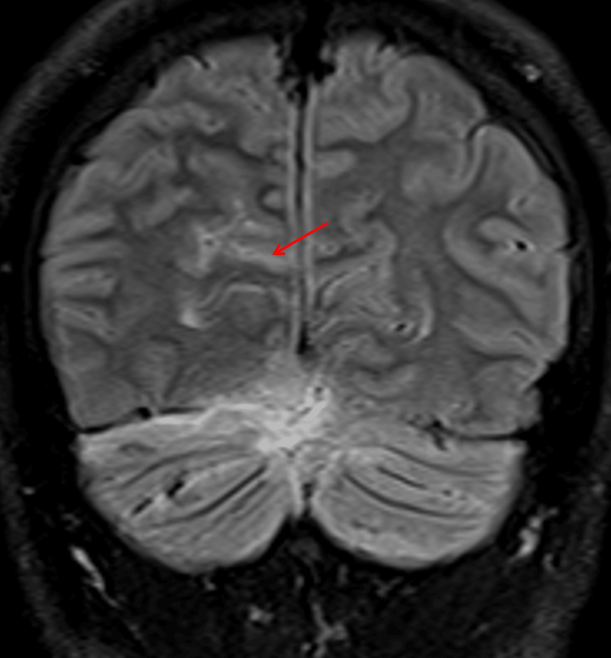 FLAIR signal hyperintensity in a right occipital sulcus (red arrow), which may also relate to leptomeningeal tumor dissemination.