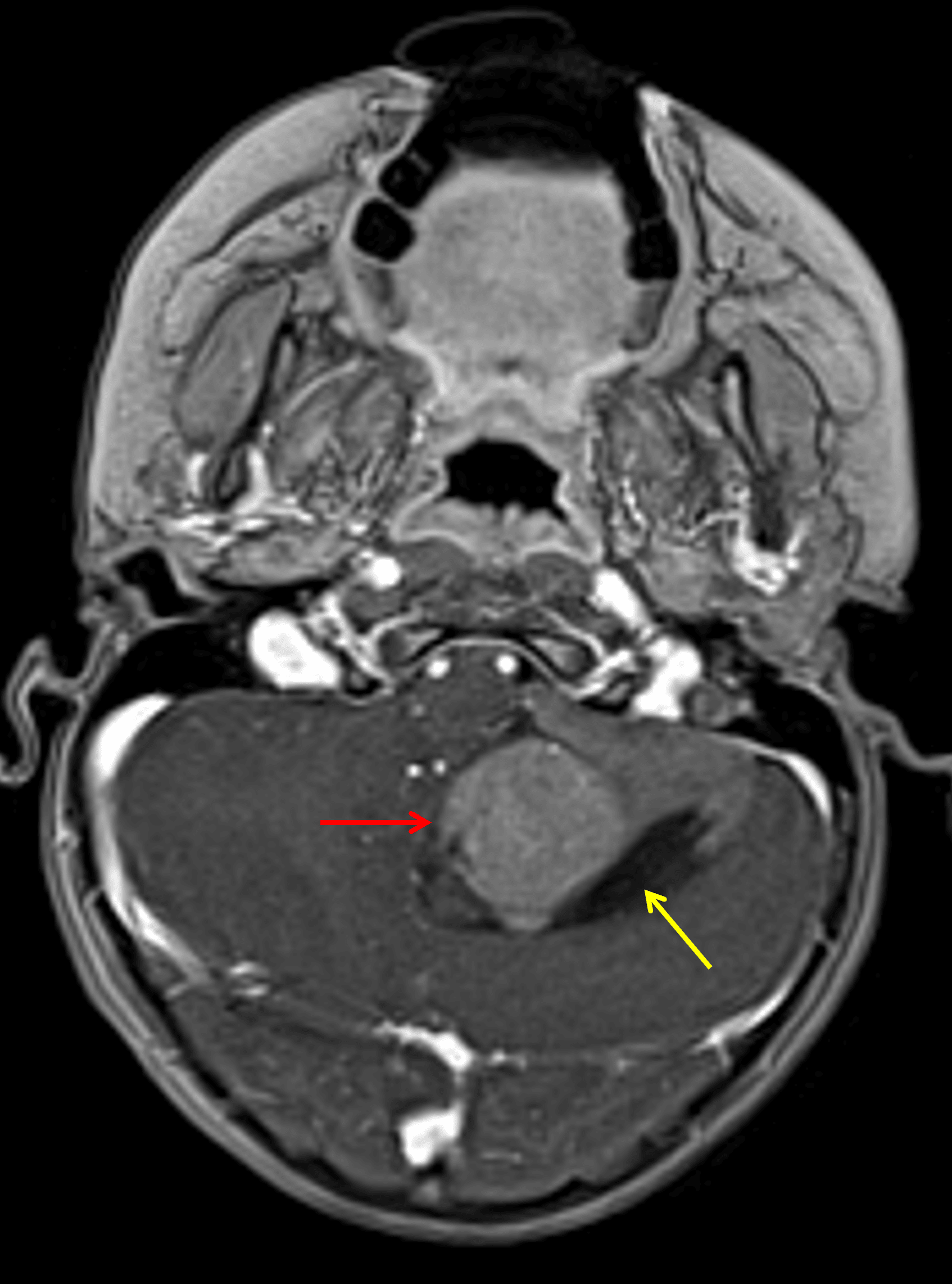 Enhancing mass centered in the left cerebellar hemisphere (red arrow) with a peripheral cystic component (yellow arrow).