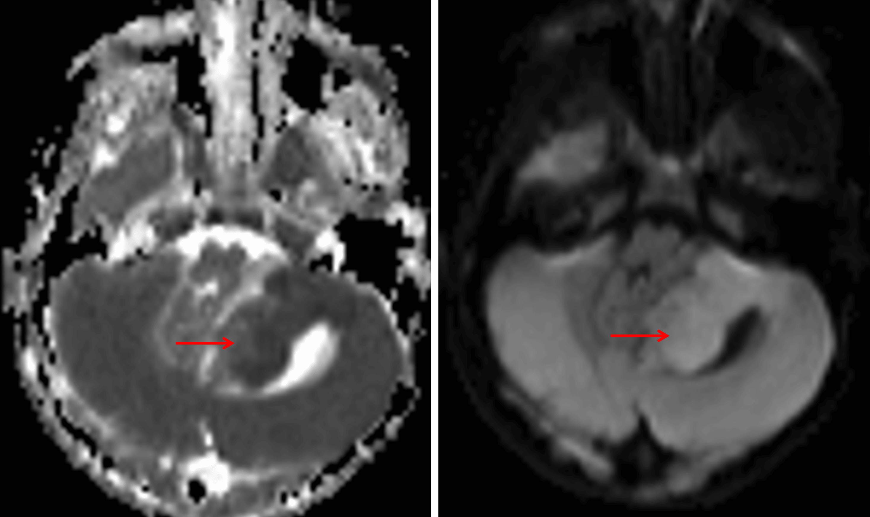 Mild corresponding restricted diffusion (red arrows).