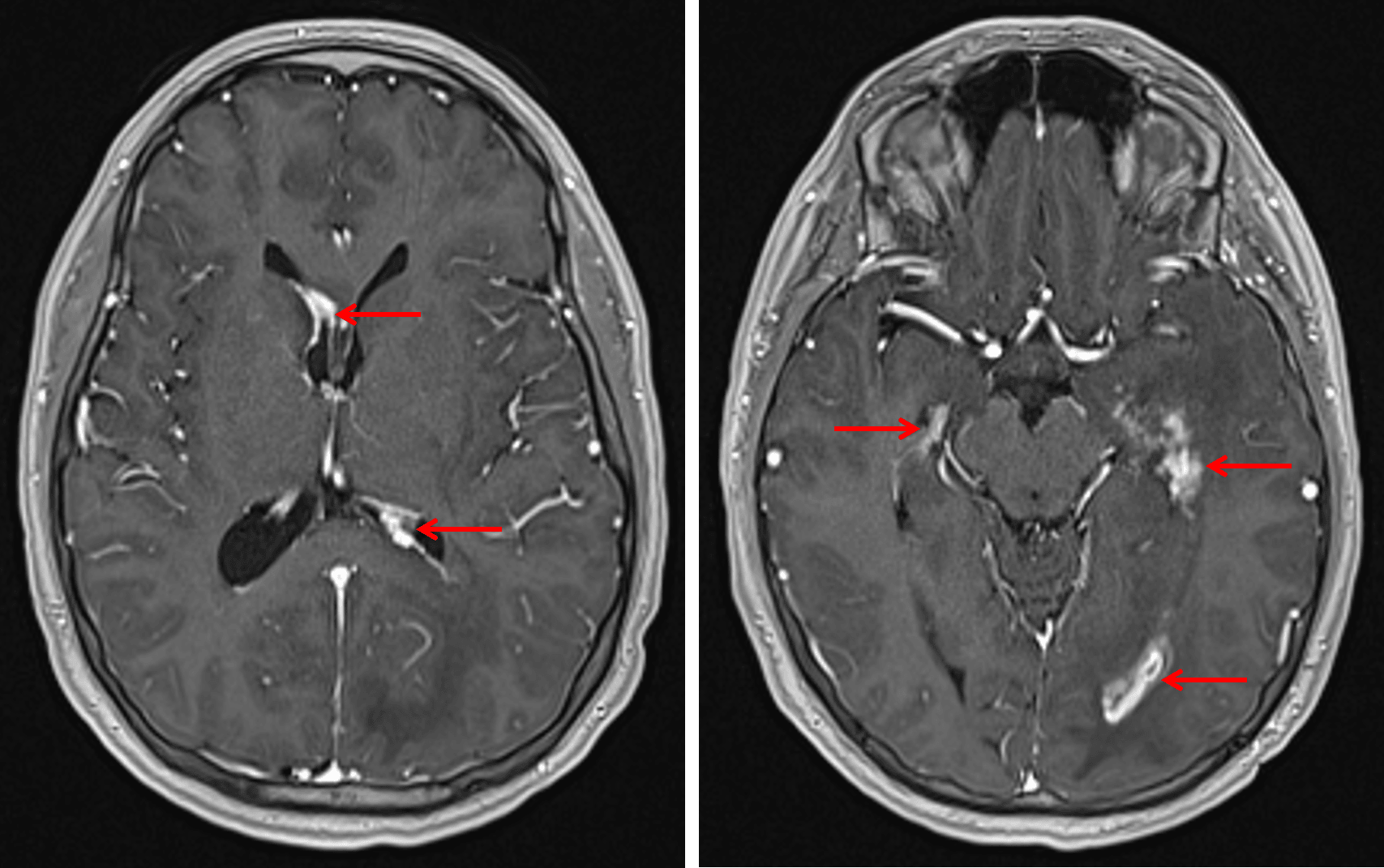 Multiple sites of nodular enhancement along the margins of the lateral ventricles (red arrows) in this patient with neurosarcoidosis.