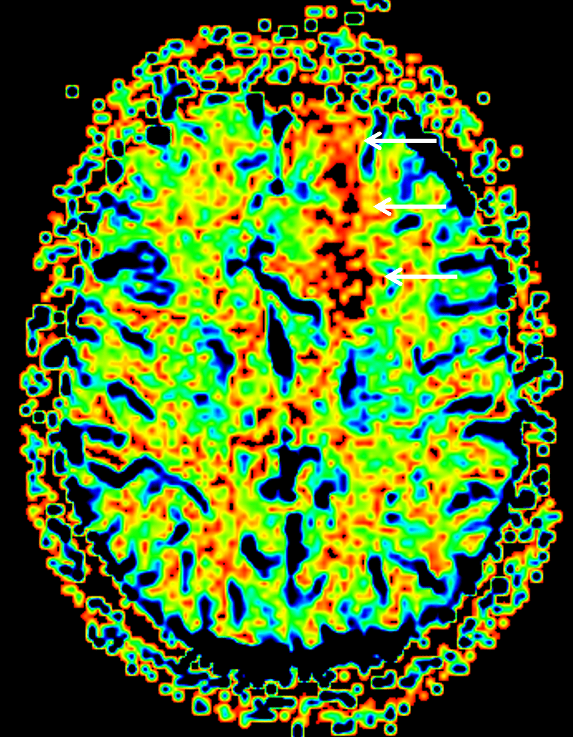 Cerebral blood volume map demonstrates relatively elevated cerebral blood volume corresponding to the left frontal mass (white arrows).