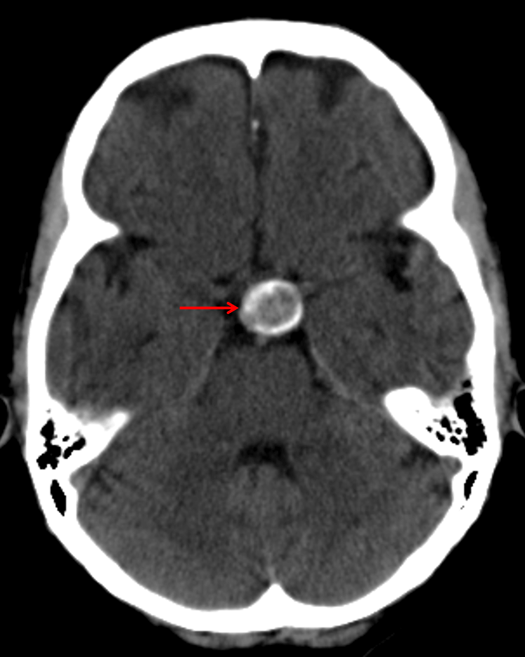 Calcified suprasellar mass (red arrow).