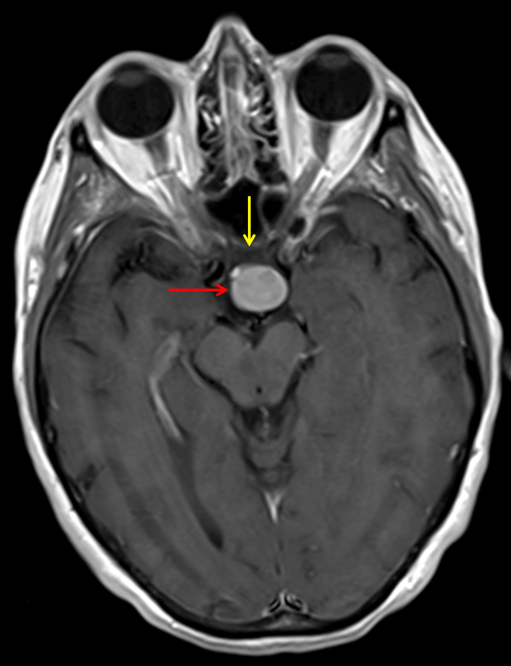 Diffuse corresponding enhancement (red arrow). The mass contacts the posterior aspect of the optic chiasm (yellow arrow).