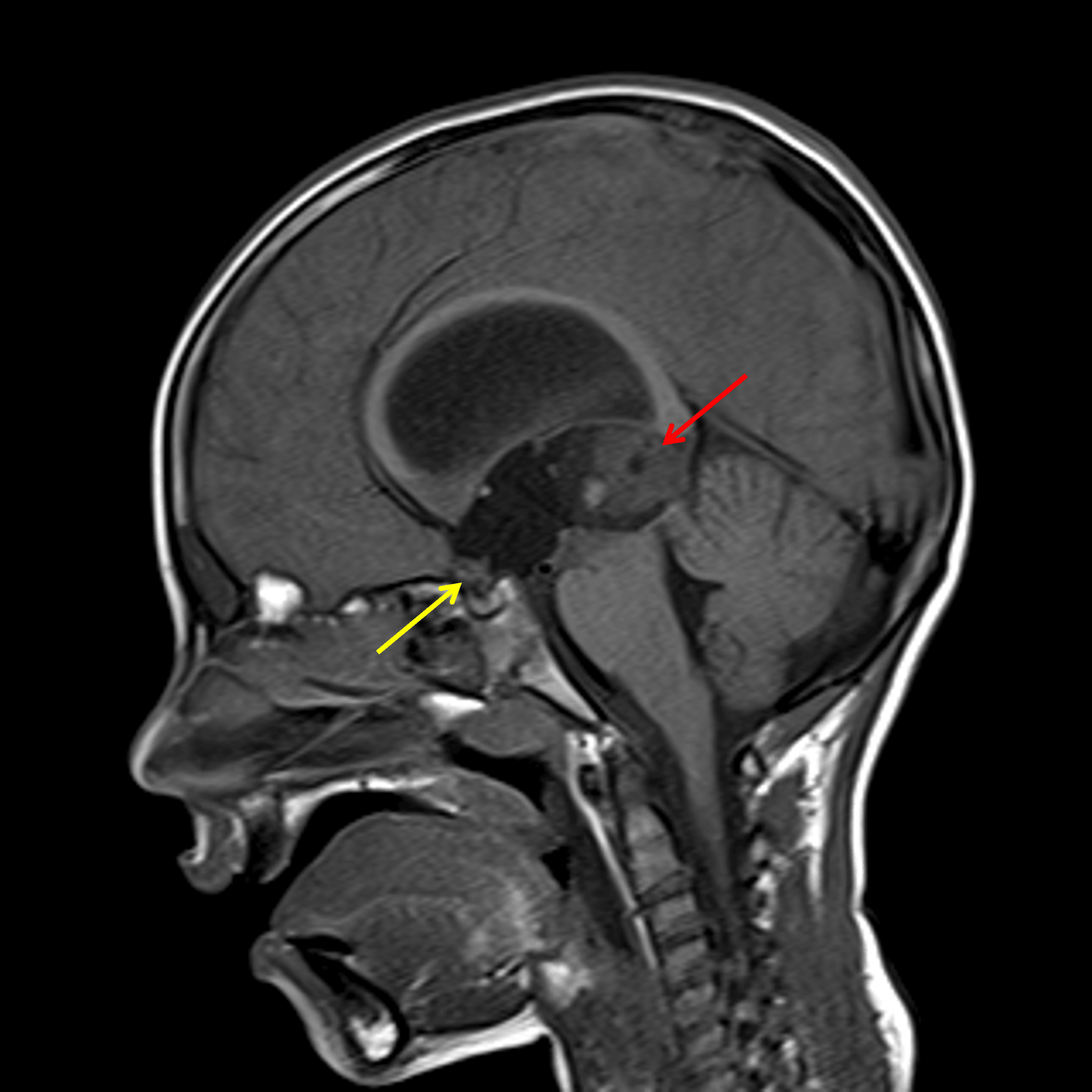 Dominant mass in the pineal region (red arrow) with a smaller mass anteriorly centered in the anterior recesses of the third ventricle (yellow arrow).