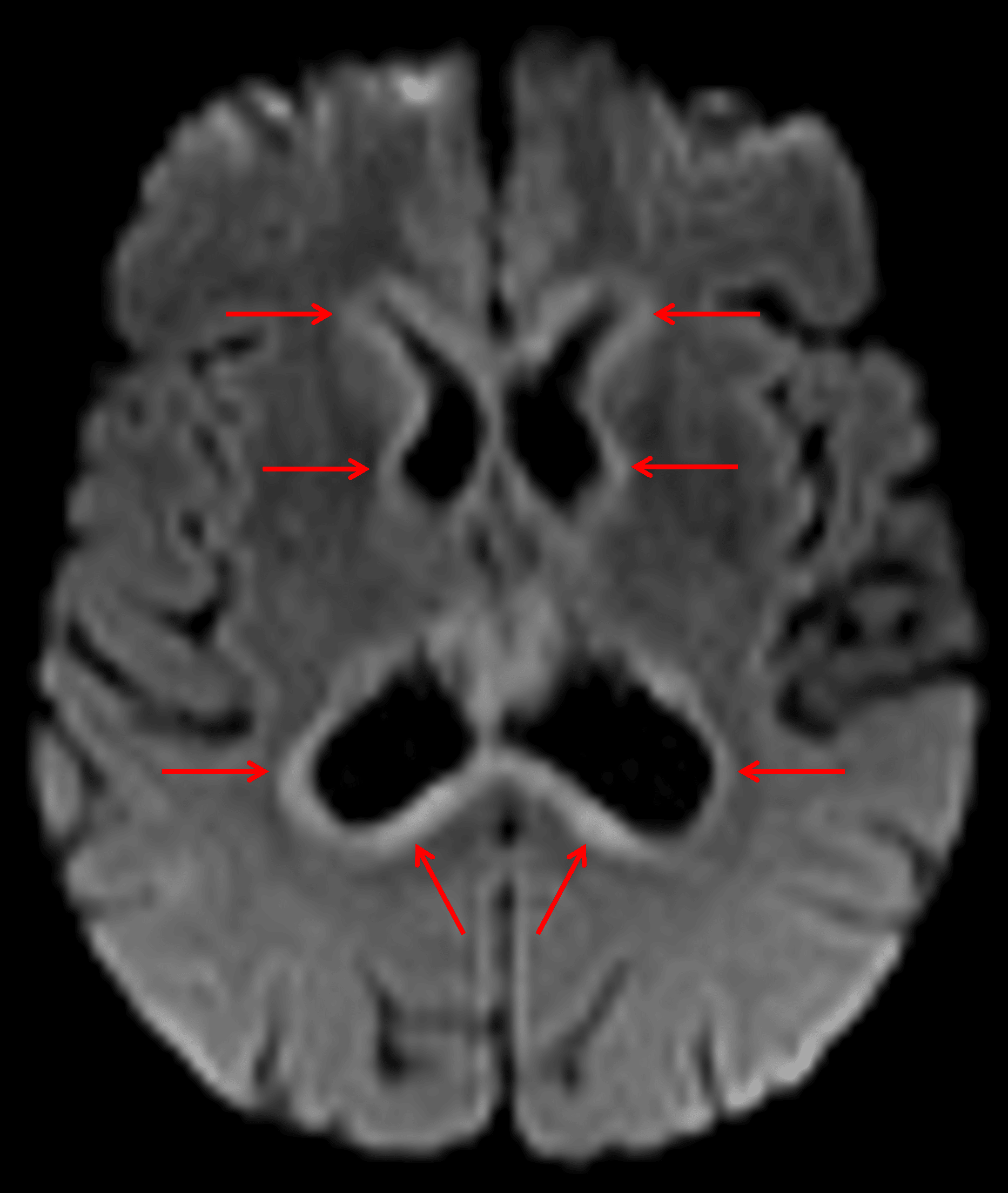 Diffuse rim of restricted diffusion around the ventricles (red arrows), which is a typical appearance for secondary CNS lymphoma.