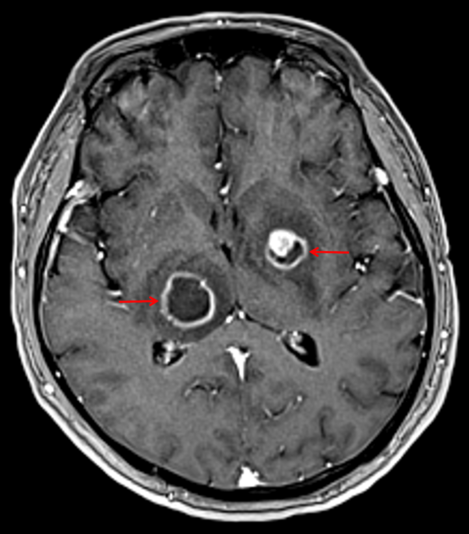 Peripherally-enhancing lesions in the right thalamus and left lentiform nucleus (red arrows).