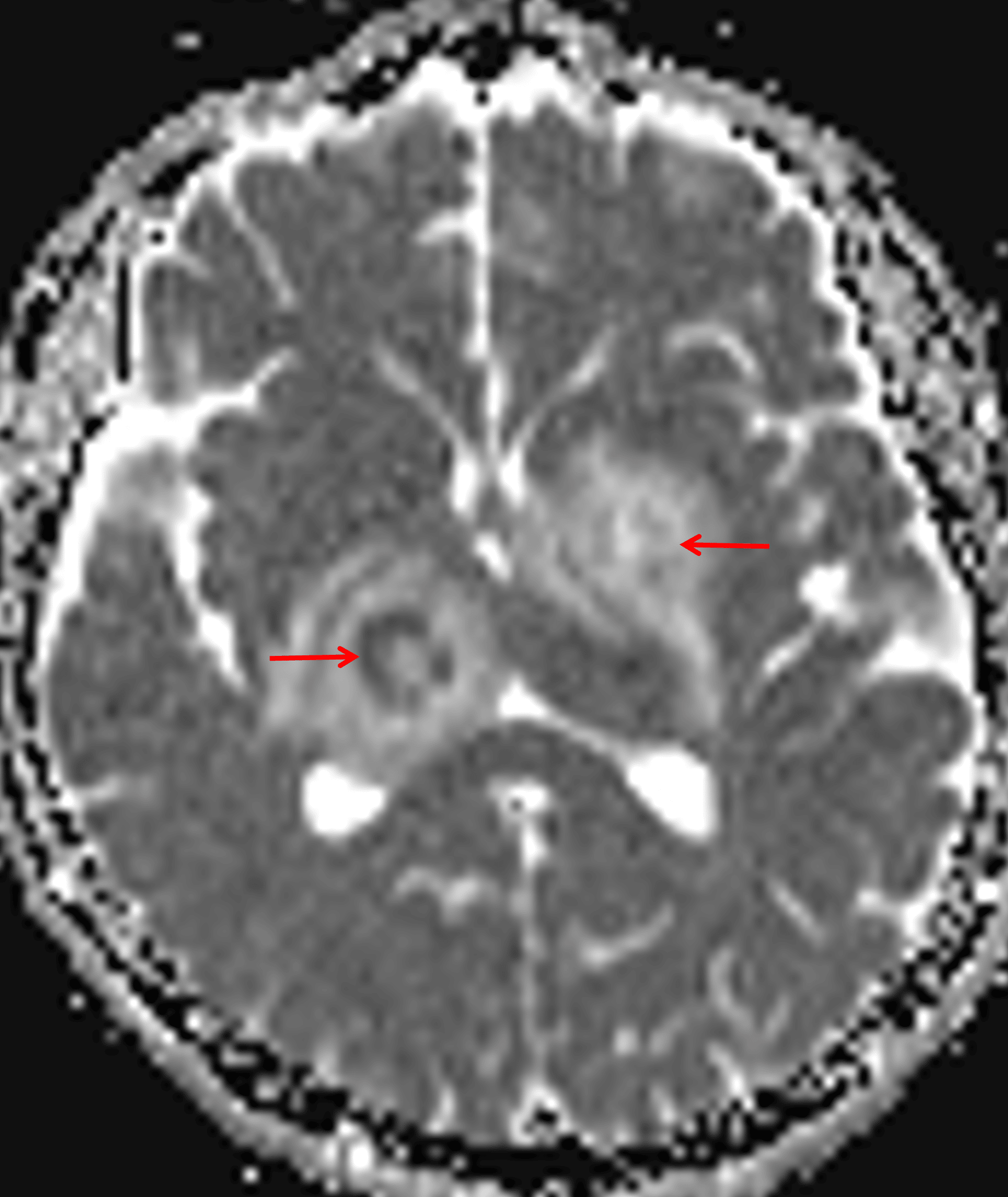 Peripheral restricted diffusion, more pronounced with the right thalamic lesion (red arrows).