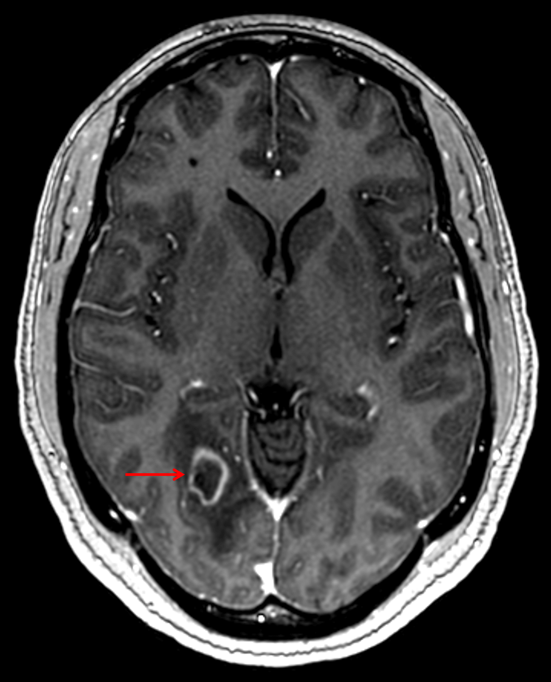 Peripherally-enhancing lesion in the right occipital lobe (red arrow) with surrounding vasogenic edema.