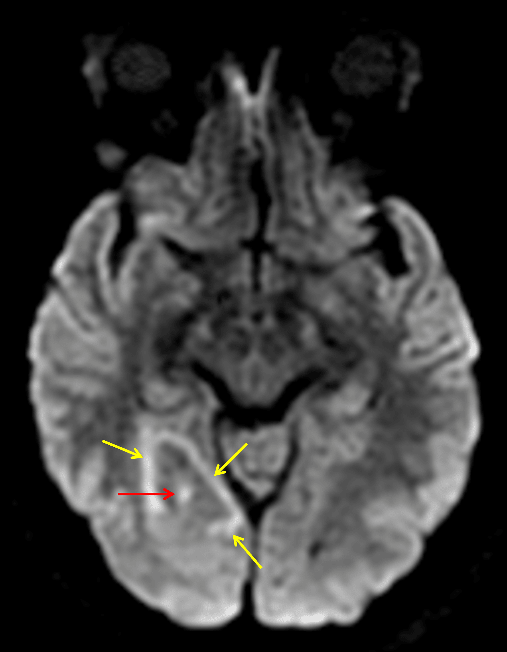 Faint corresponding central restricted diffusion (red arrow) as well as faint restricted diffusion along the periphery of the surrounding vasogenic edema (yellow arrows).
