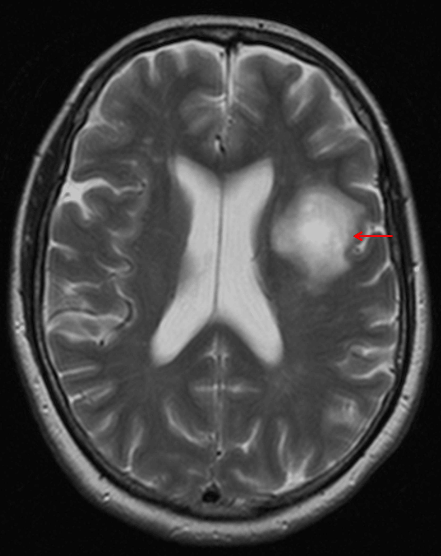Masslike area of T2 signal hyperintensity in the left frontal white matter (red arrow) with surprisingly essentially no mass effect on the left lateral ventricle or adjacent sulci.