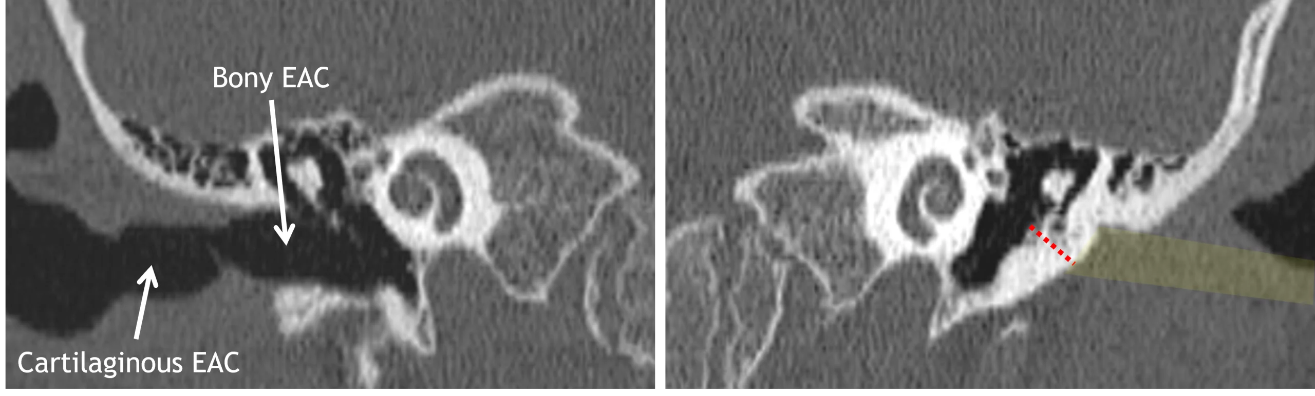 Normal right EAC (image to the left) with normal cartilaginous and bony segments. Atretic left EAC (image to the right), with the approximate expected location of the EAC highlighted in yellow and the red dotted line measuring the width of the bony plate where the bony portion of the EAC should be.