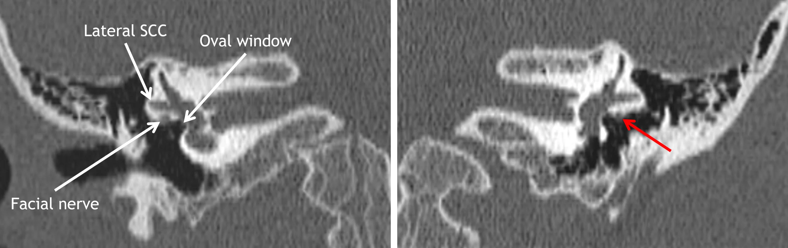 Normal right side (image on the left) with the tympanic segment of the facial nerve coursing immediately inferior to the lateral semicircular canal, not obstructing the oval window. Abnormal left side (image on the right) with an abnormally inferior, partially uncovered tympanic segment of the facial nerve (red arrow).