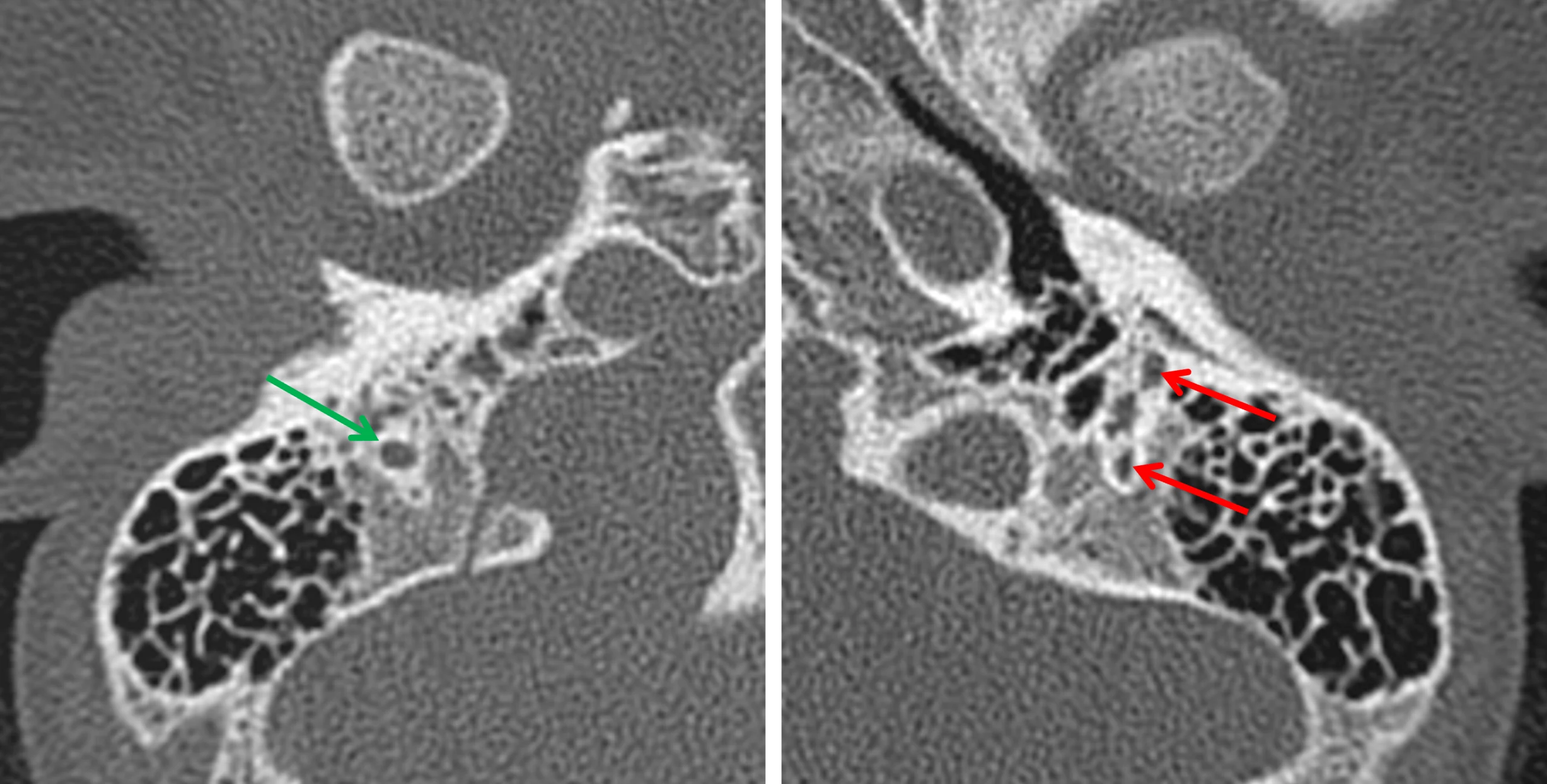 Normal course of the mastoid segment of the right facial nerve (image on the right, green arrow). Abnormal splitting of the mastoid segment of the left facial nerve with a larger canal coursing anteriorly (image on the right, red arrows).