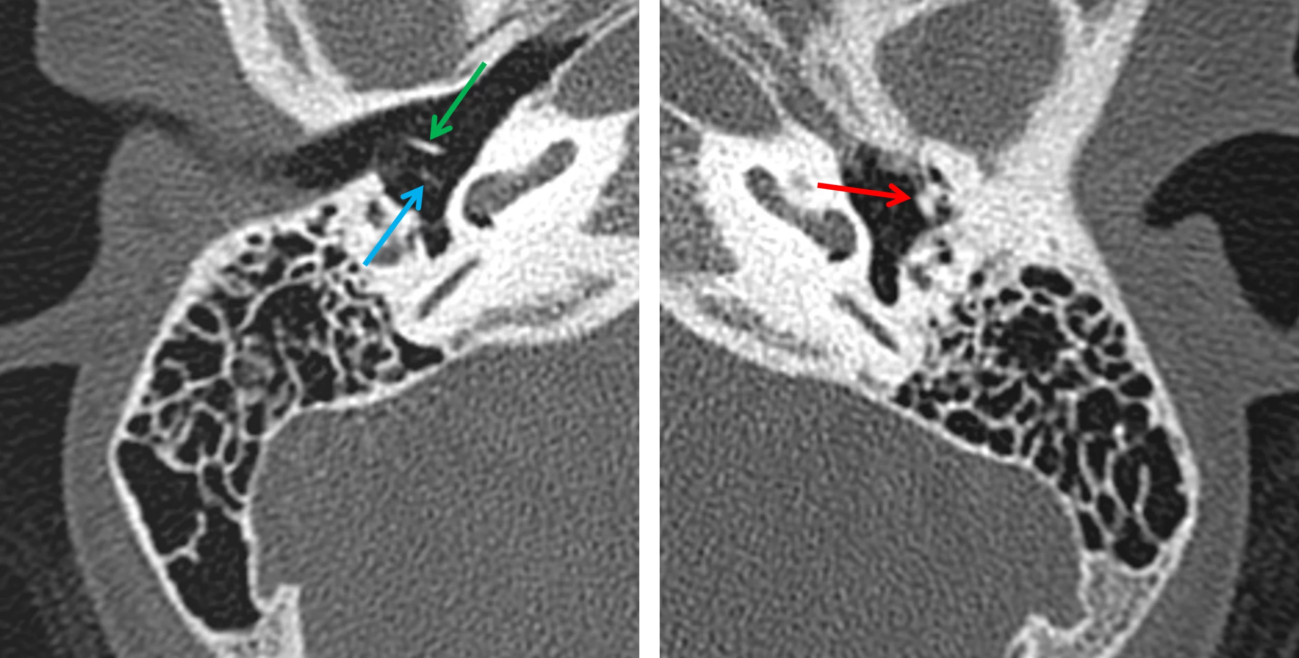 Normal morphology and orientation of the ossicles on the right (image on the left) with the handle of the malleus (green arrow) and long process of the incus (blue arrow) oriented perpendicular to each other. Abnormal morphology of the malleus and incus on the left (image on the right), which appear fused to the anterior wall of the middle ear (red arrow).