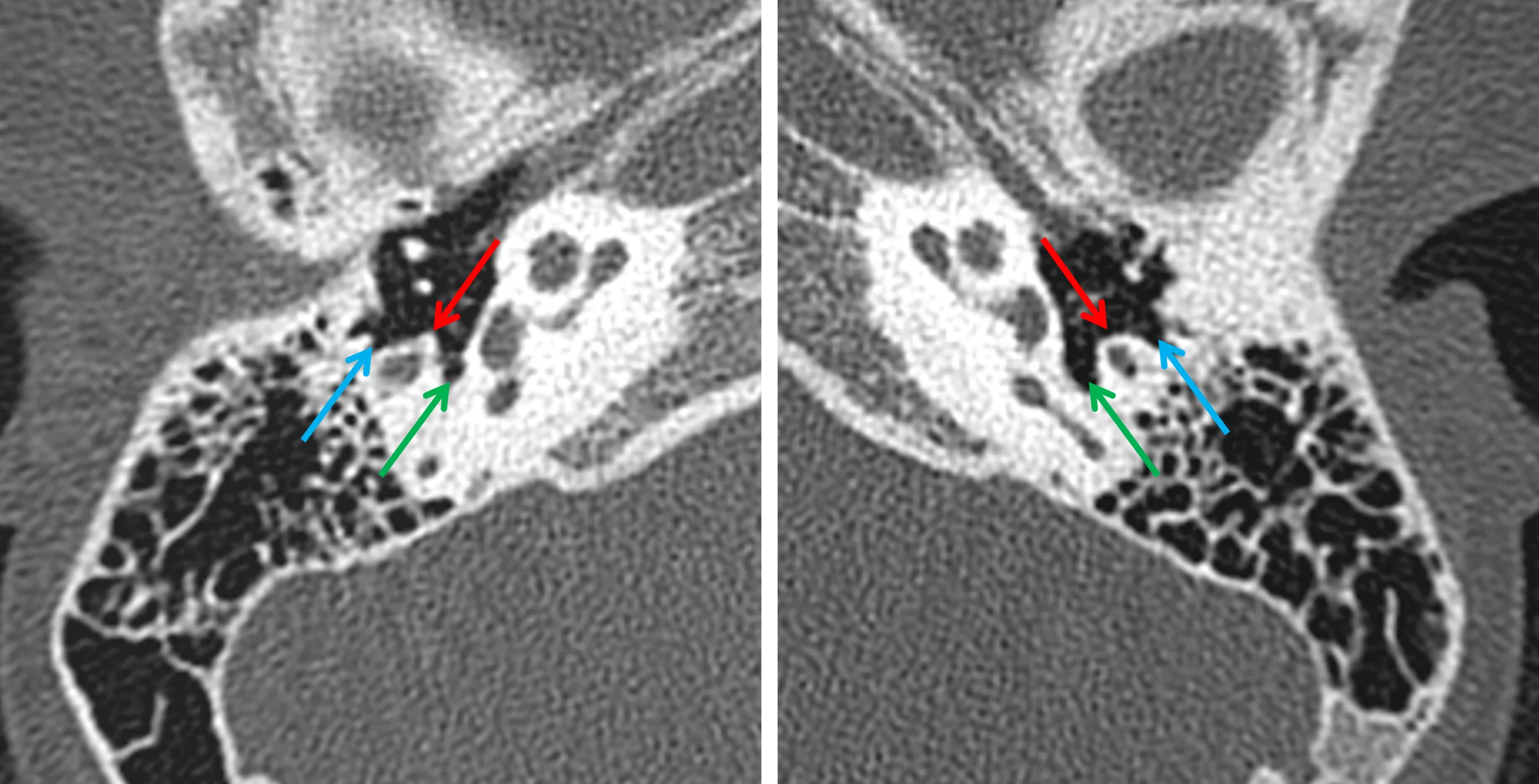 Normal right (image on the left and abnormal left (image on the right) middle ears. Blunted appearance of the pyramidal eminence (red arrows) and shallow appearance of the facial recess (blue arrows) on the left. Green arrows indicate the sinus tympani.