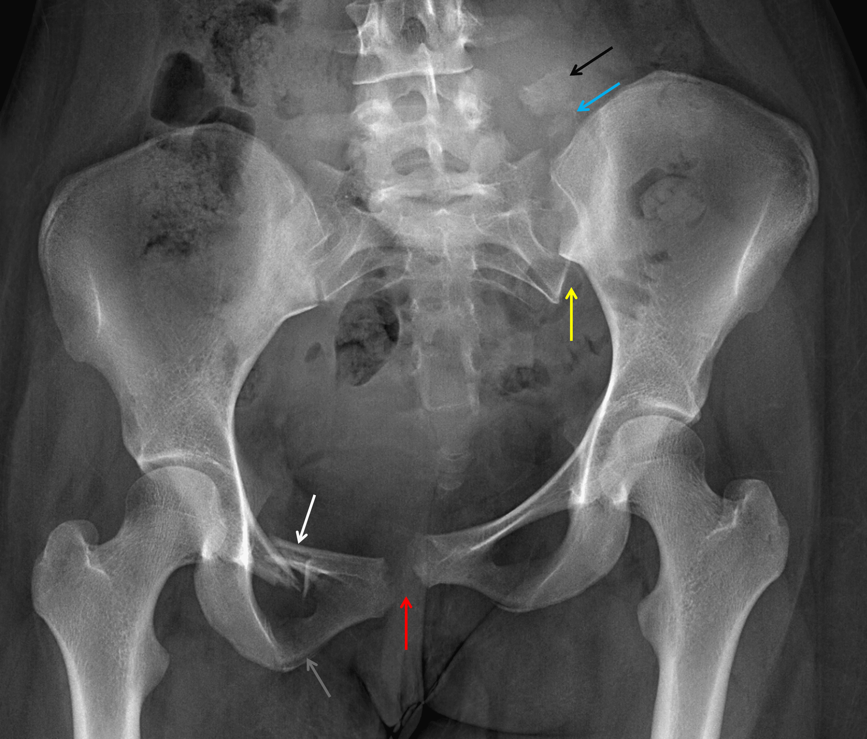 Widening and offset of the pubic symphysis (red arrow) and left sacroiliac joint (yellow arrow). Fractures of the right superior (white arrow) and inferior (gray arrow) pubic rami. Displaced fractures of the left sacral ala (blue arrow) and left L5 transverse process (black arrow).