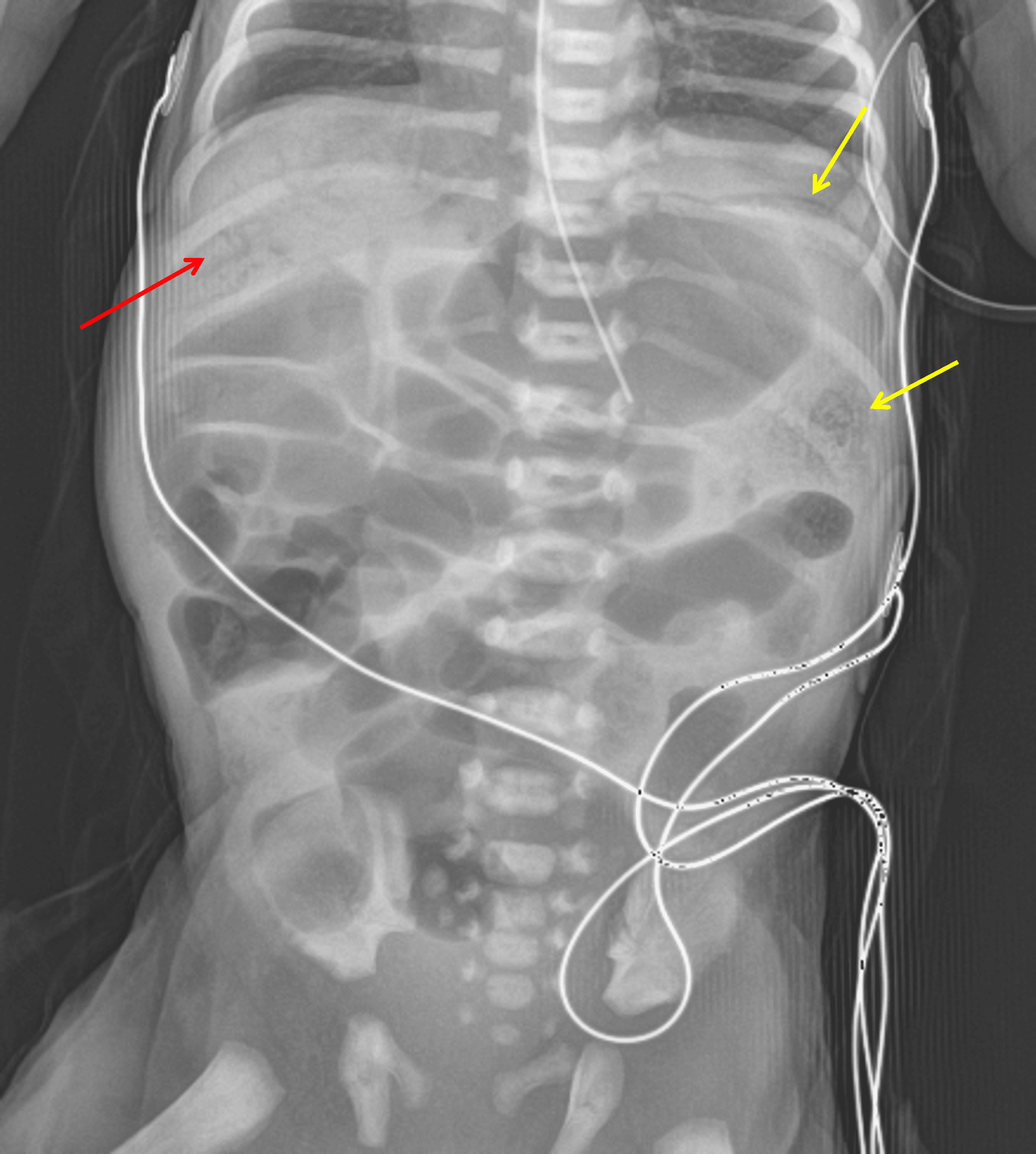 Red arrow: multiple branching lucencies overlying the liver consistent with portal venous gas. Yellow arrows: curvilinear and mottled lucencies along bowel loops in the left upper quadrant.