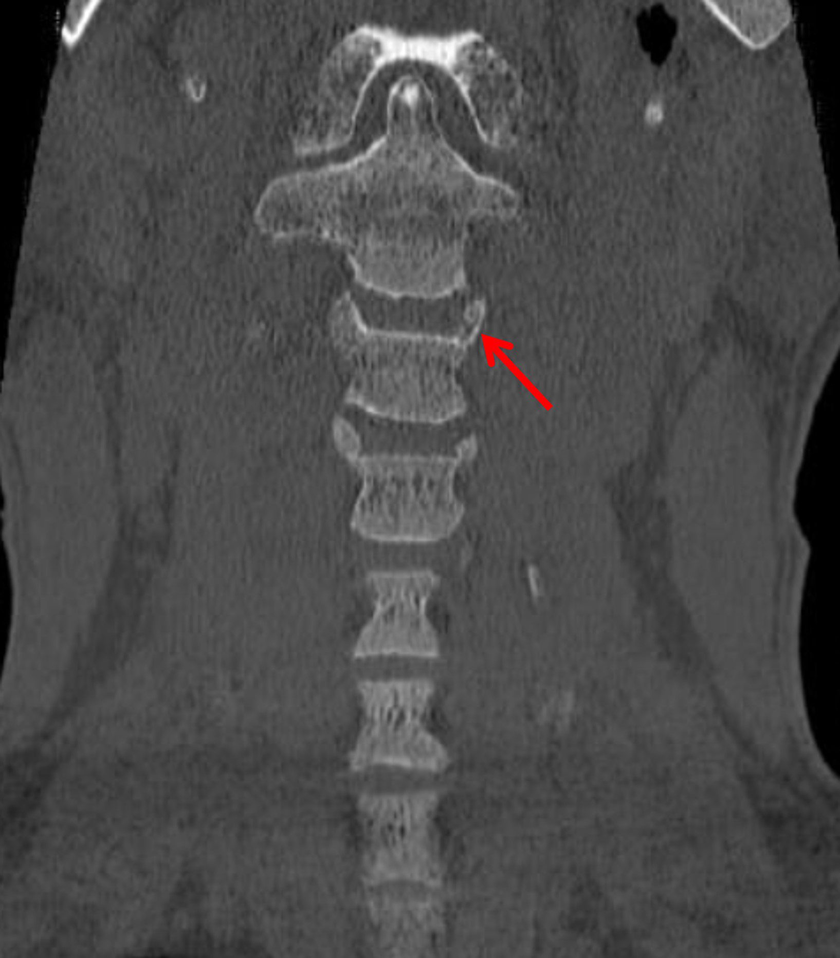 Left C3 uncinate process fracture (red arrow).