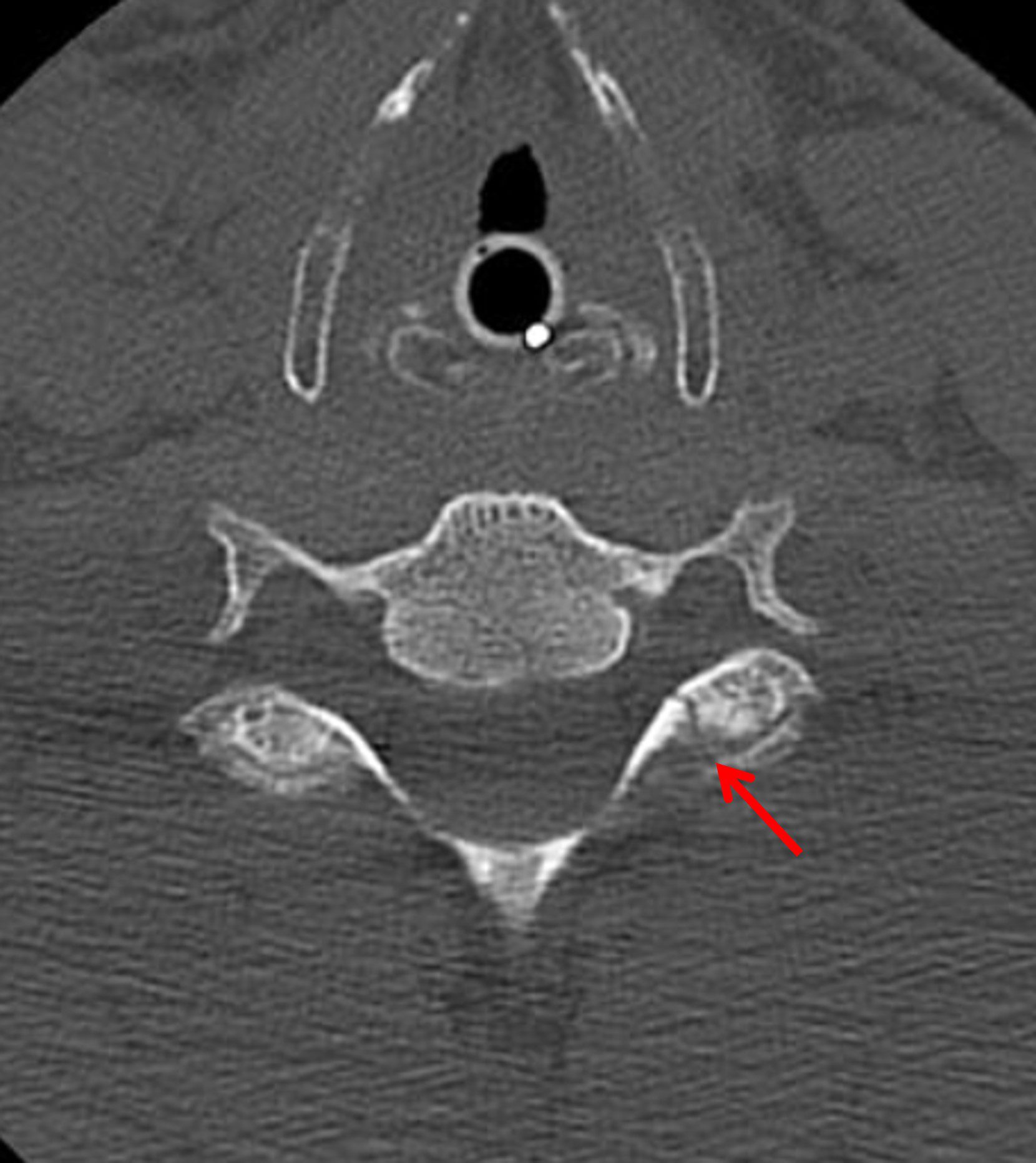Left C7 transverse process fracture (red arrow).