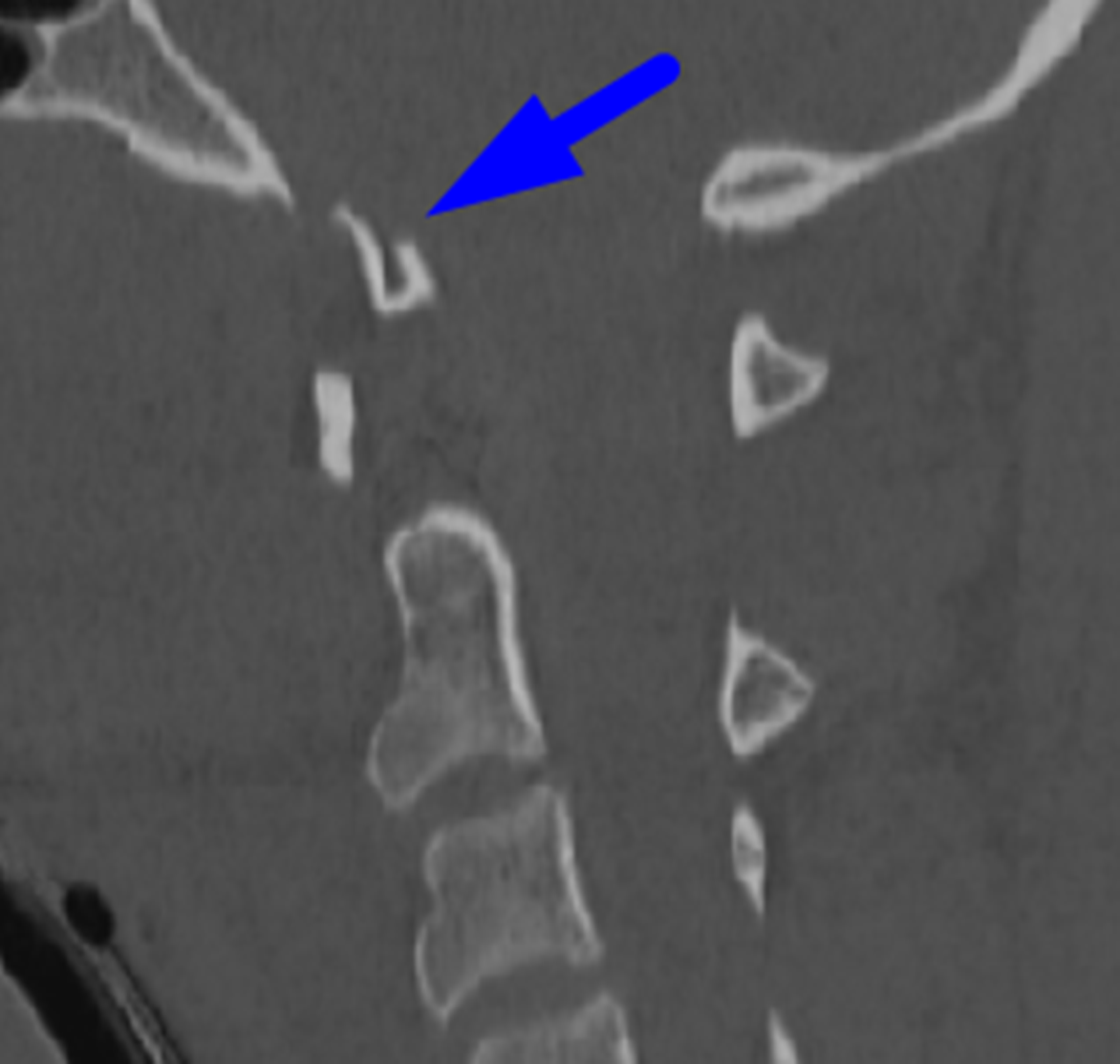 Blue arrow: displaced occipital condyle fracture.