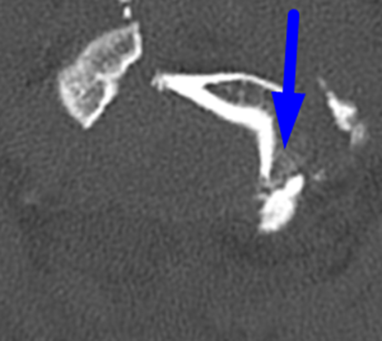 Blue arrow: displaced occipital condyle fracture.