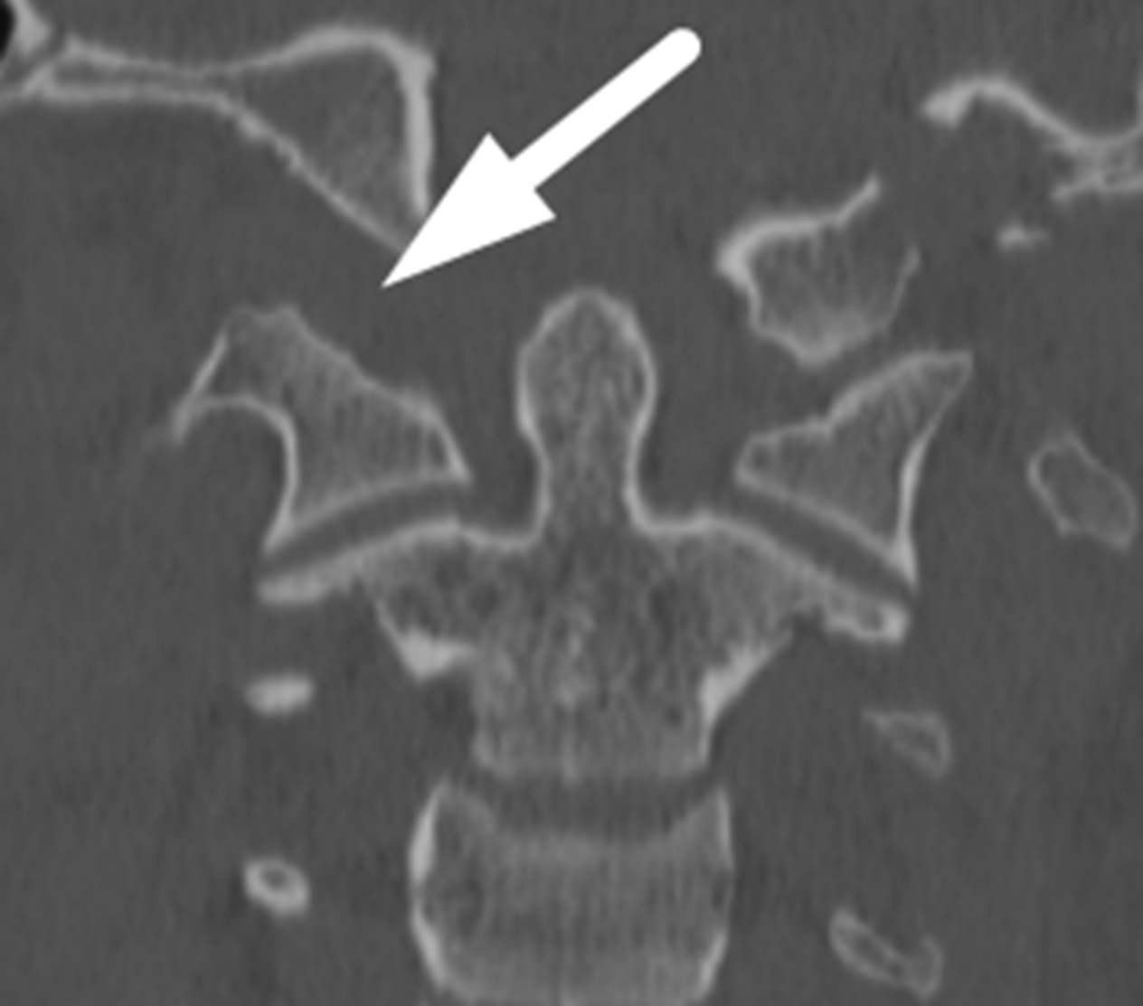 White arrow: widening of the right atlanto-occipital articulation.