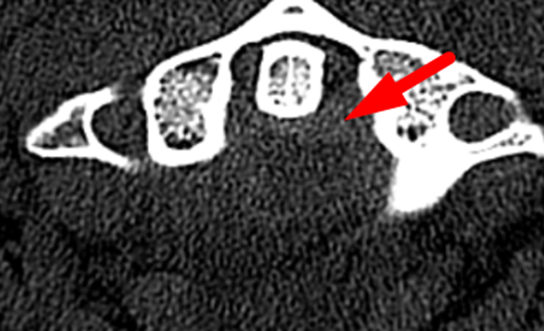 Red arrow: extra-axial hemorrhage posterior to the odontoid process.