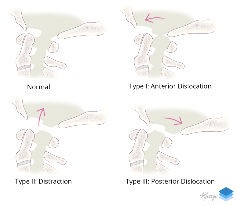 Types of craniocervical dislocation.