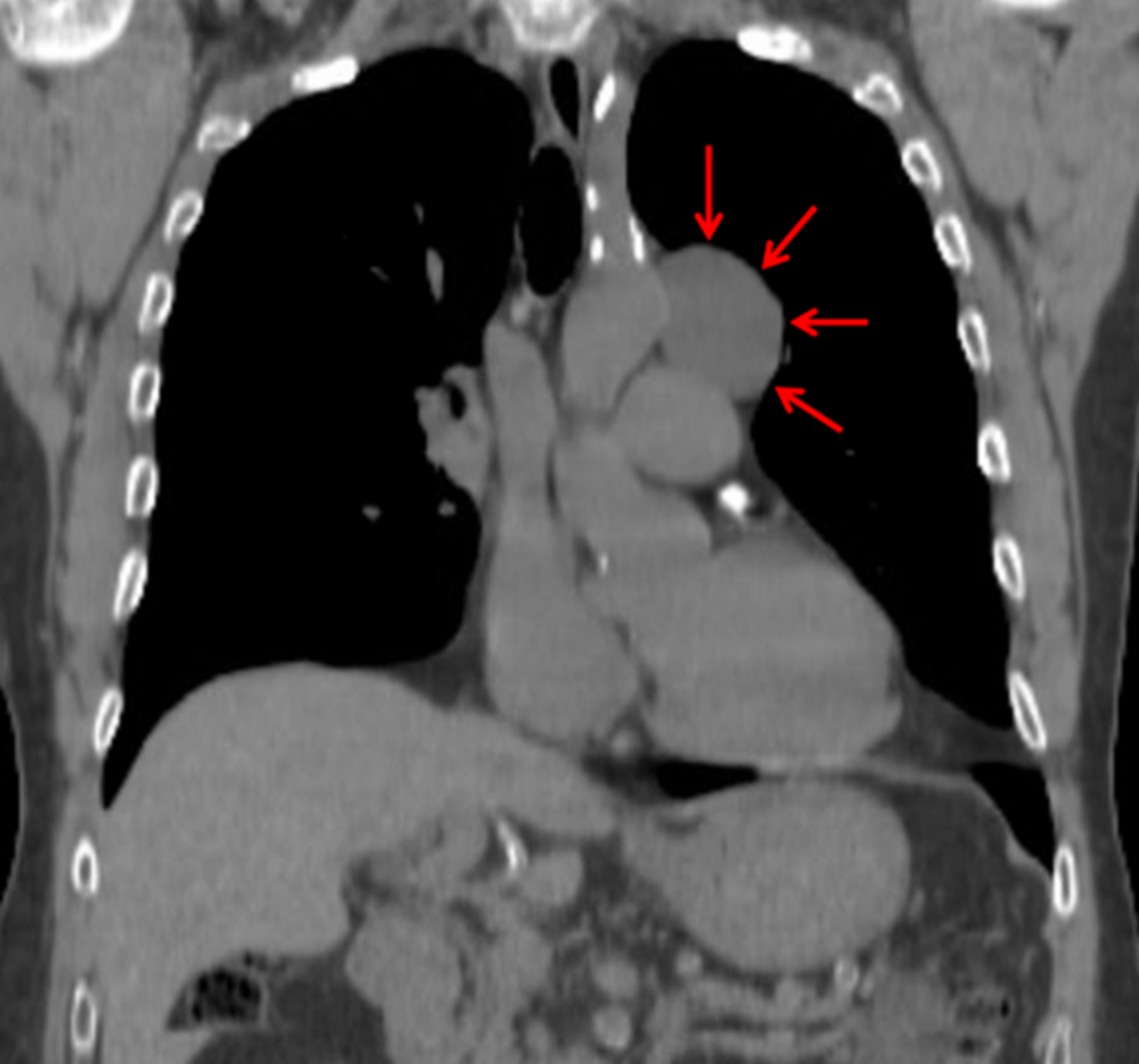 CT demonstrated a middle mediastinal mass most consistent with a benign duplication cyst (red arrows).