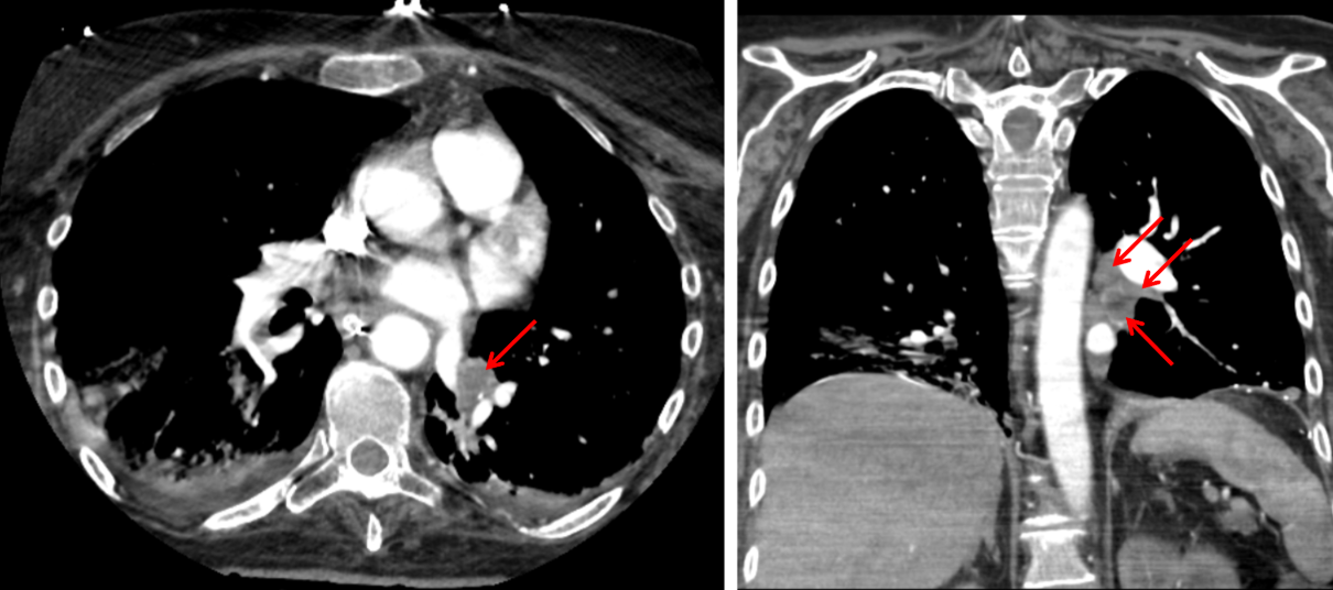 Soft tissue attenuation material filling left lower lobe bronchi (red arrows), most concerning for large volume aspiration.