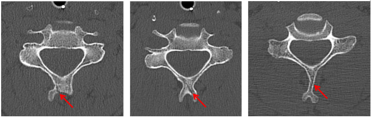C4-C6 spinous process fractures (red arrows).