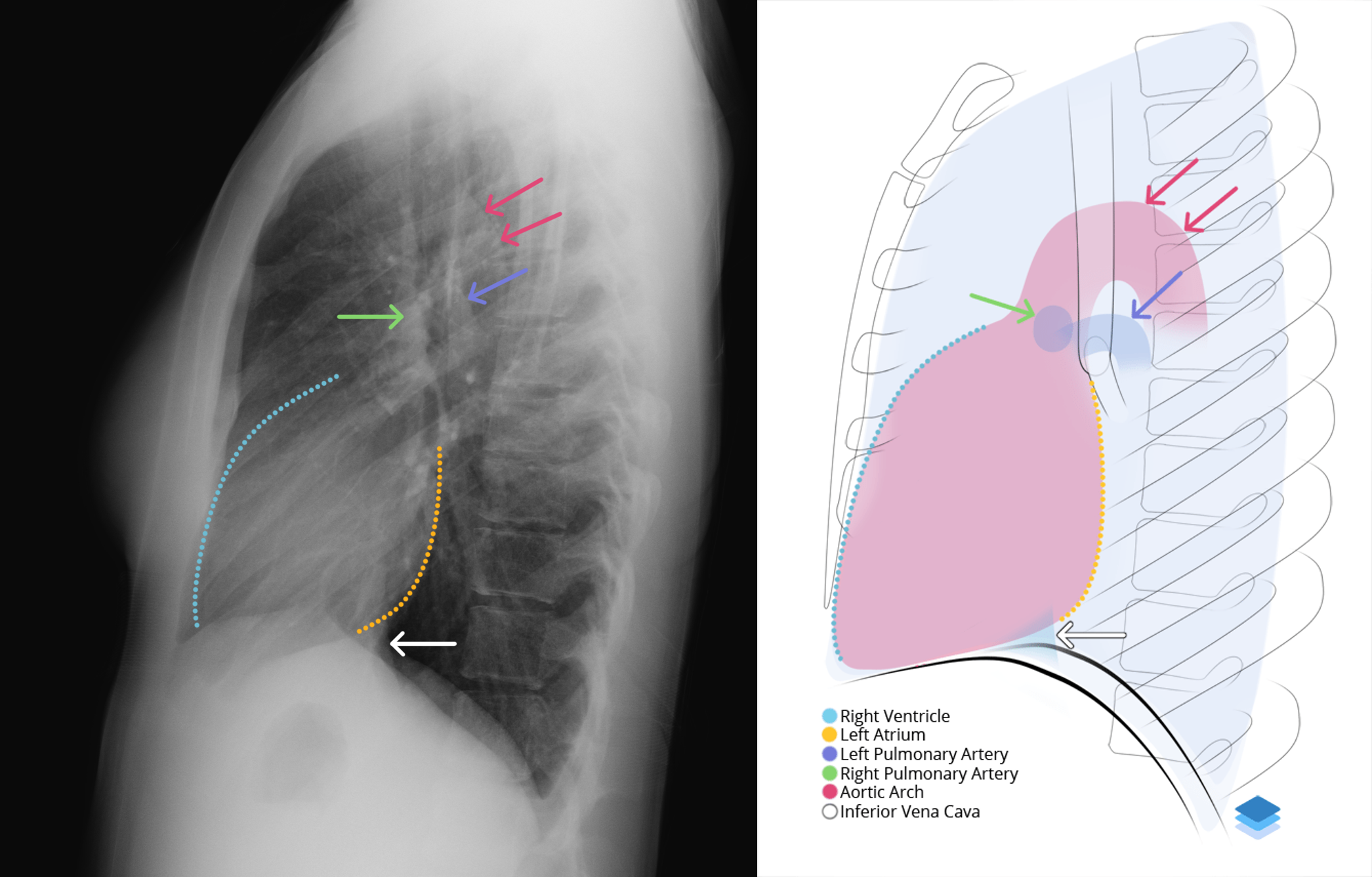 Lateral Heart and Vessels