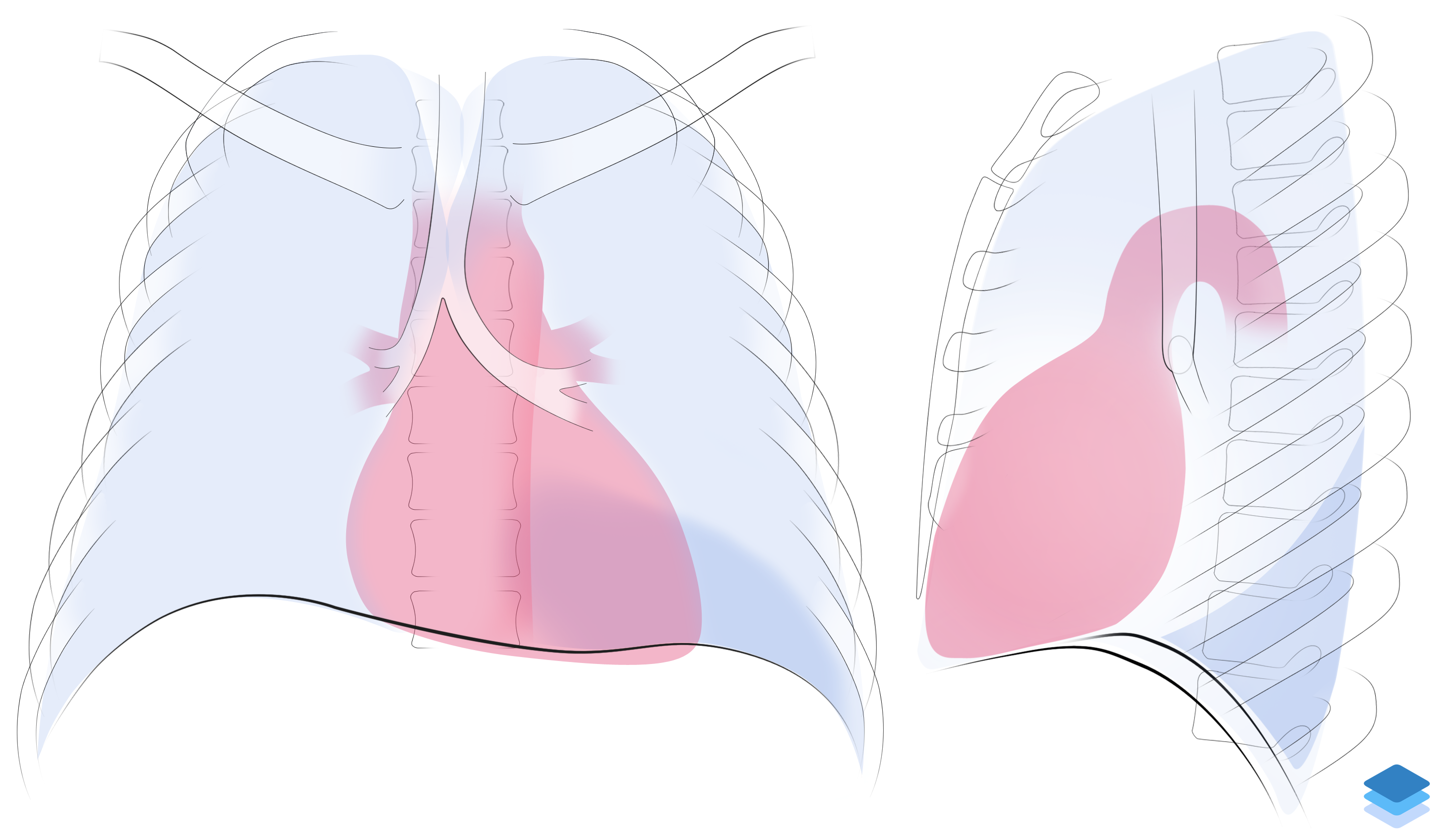Left Lower Lobe Collapse