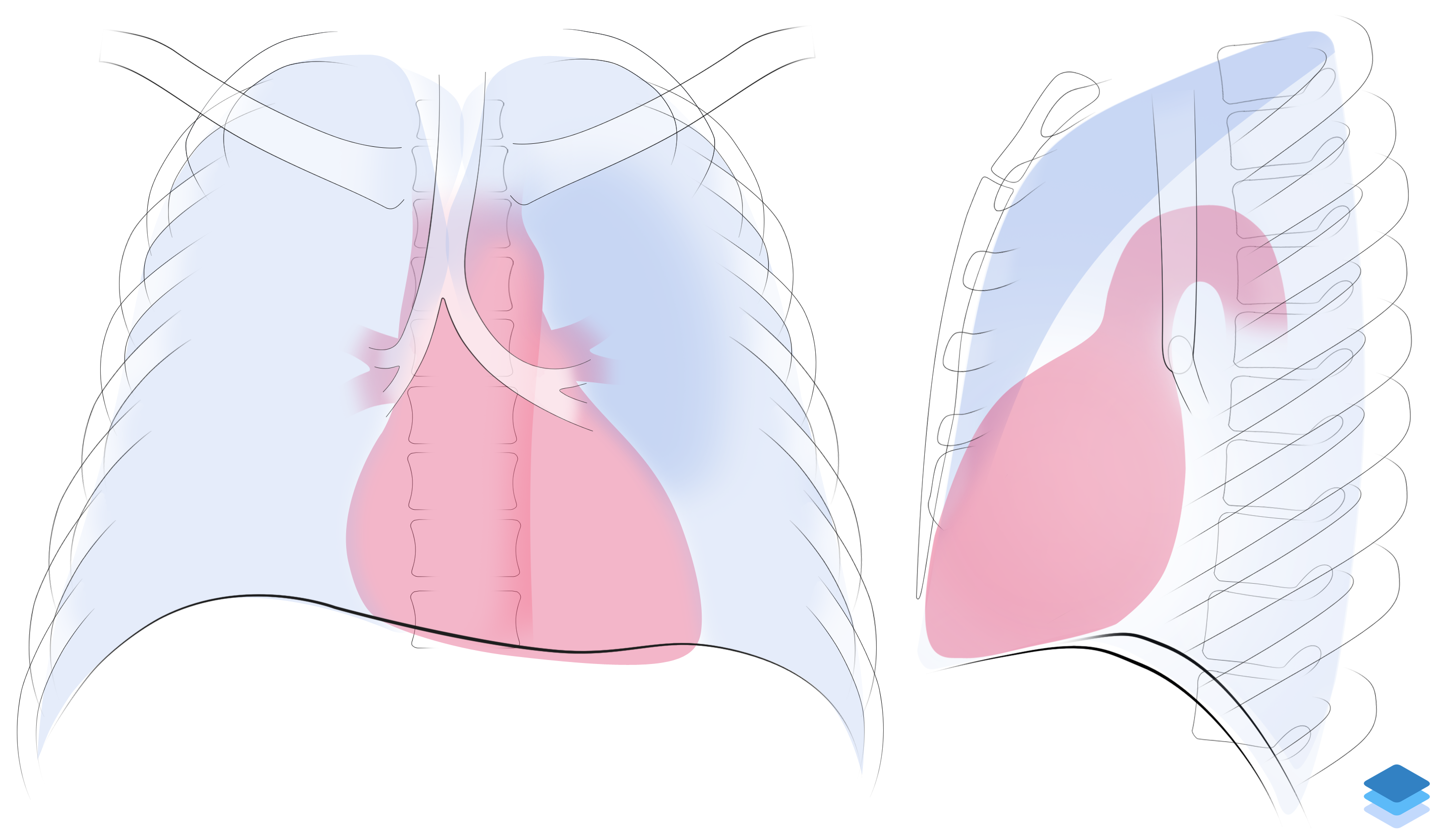 Left Upper Lobe Collapse