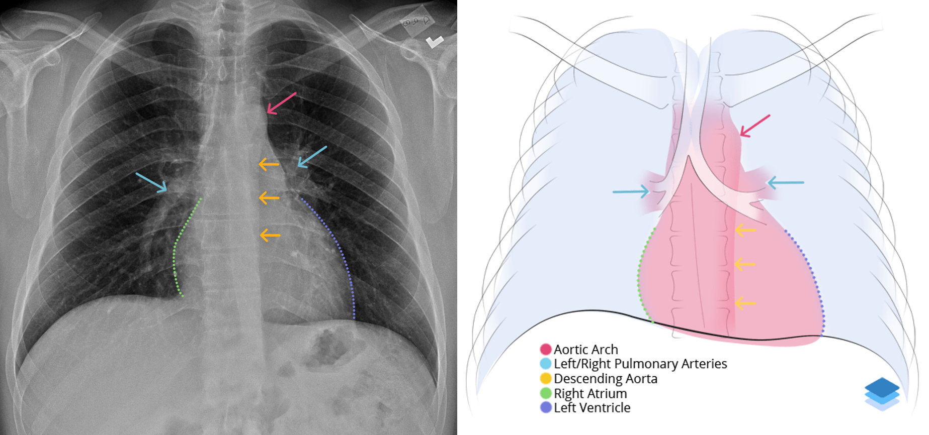 PA Heart and Vessels