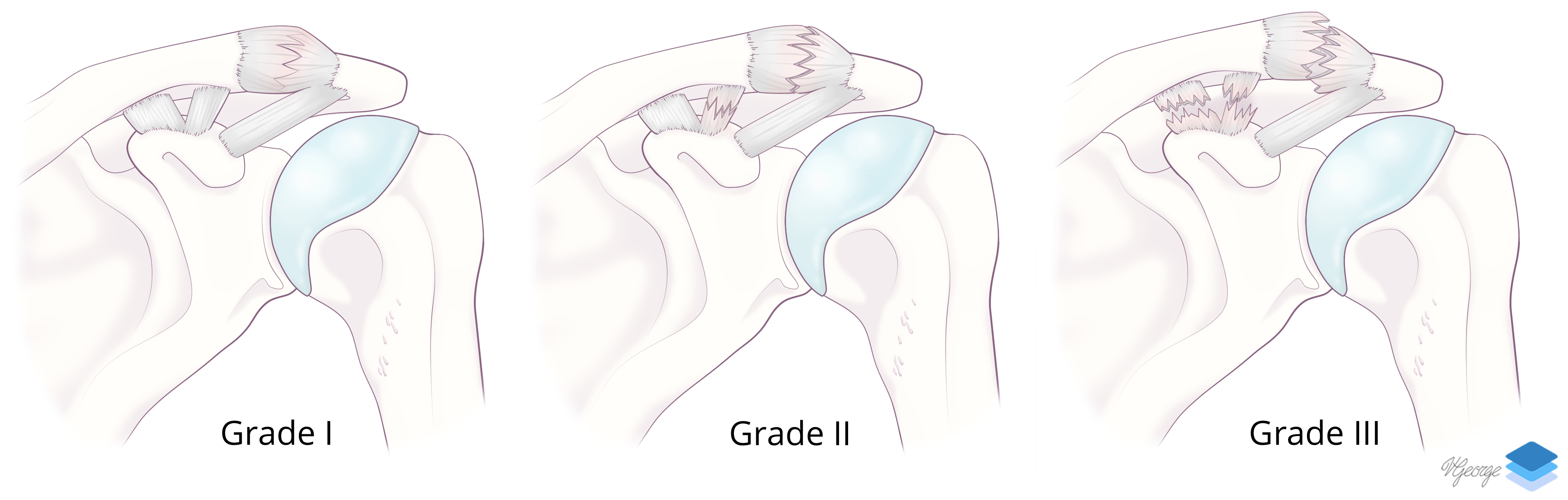 Acromioclavicular Separation