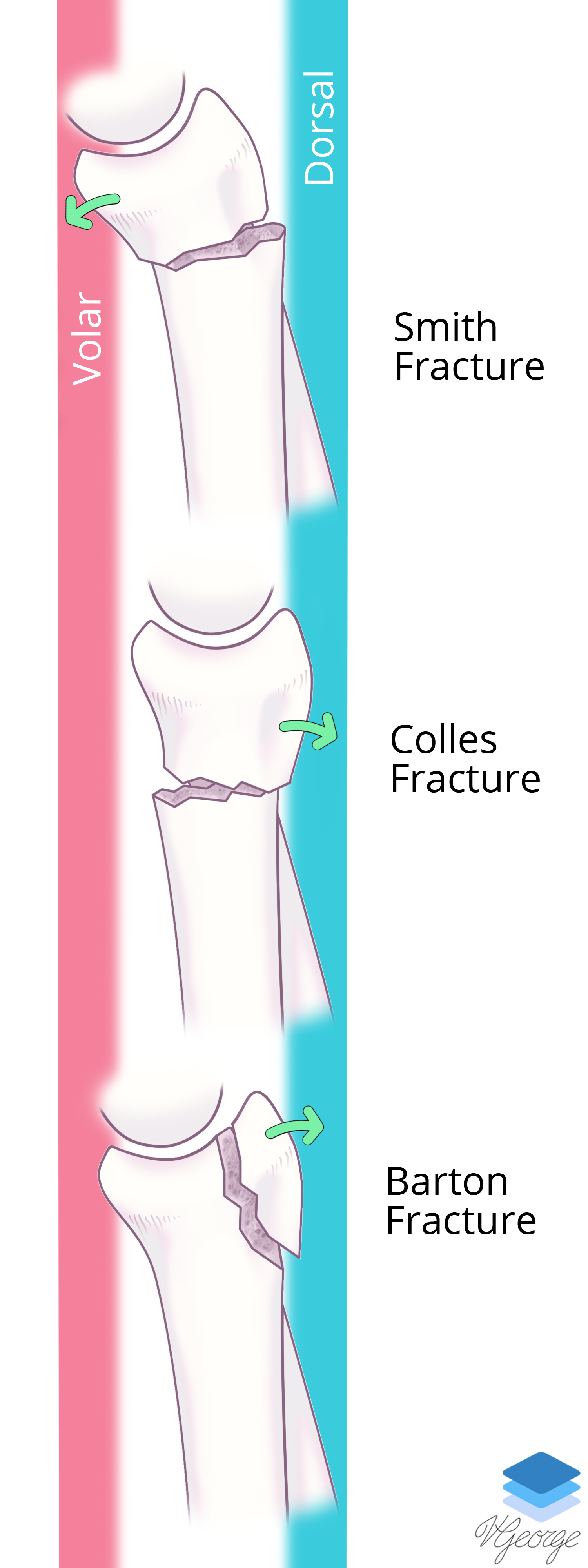 Distal Radial Fractures