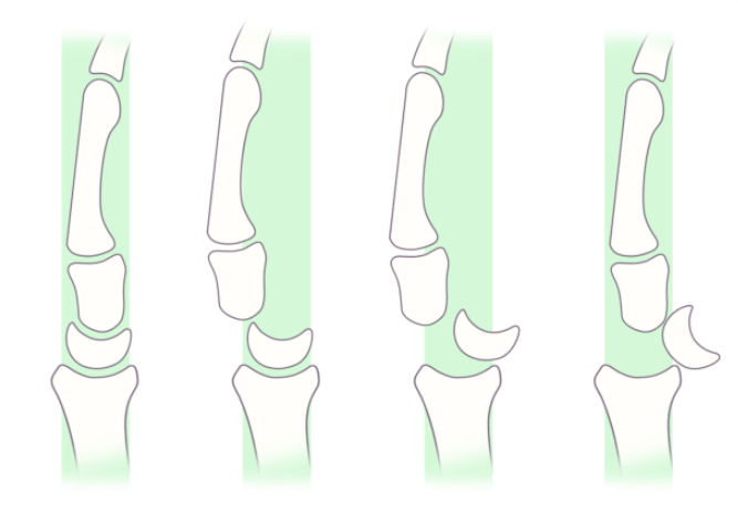 Greater Arc Carpal Dislocation