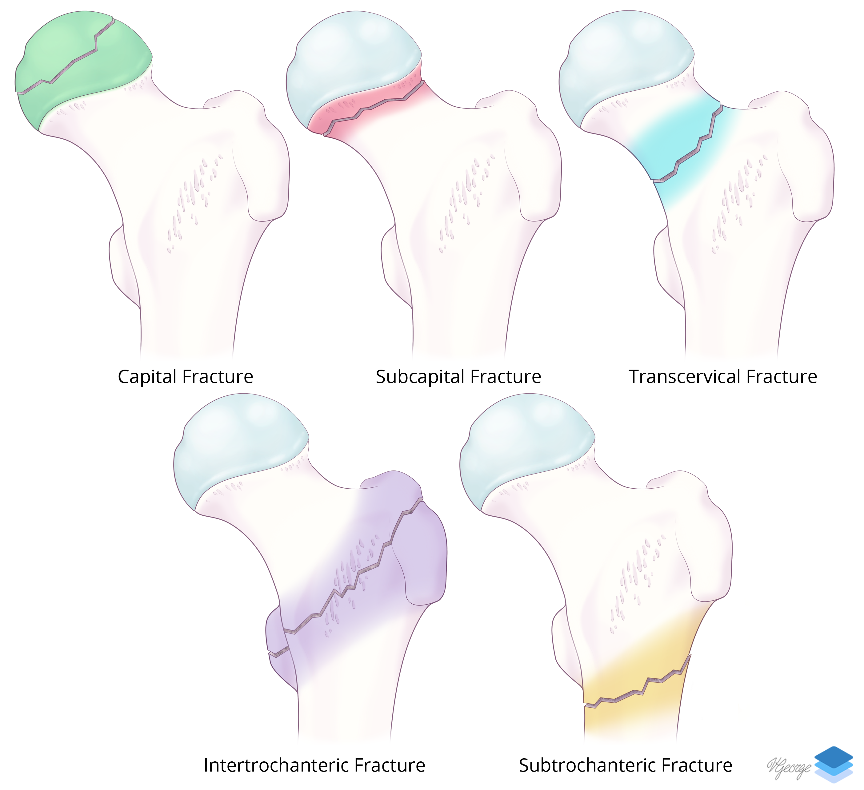 Proximal Femoral Fractures