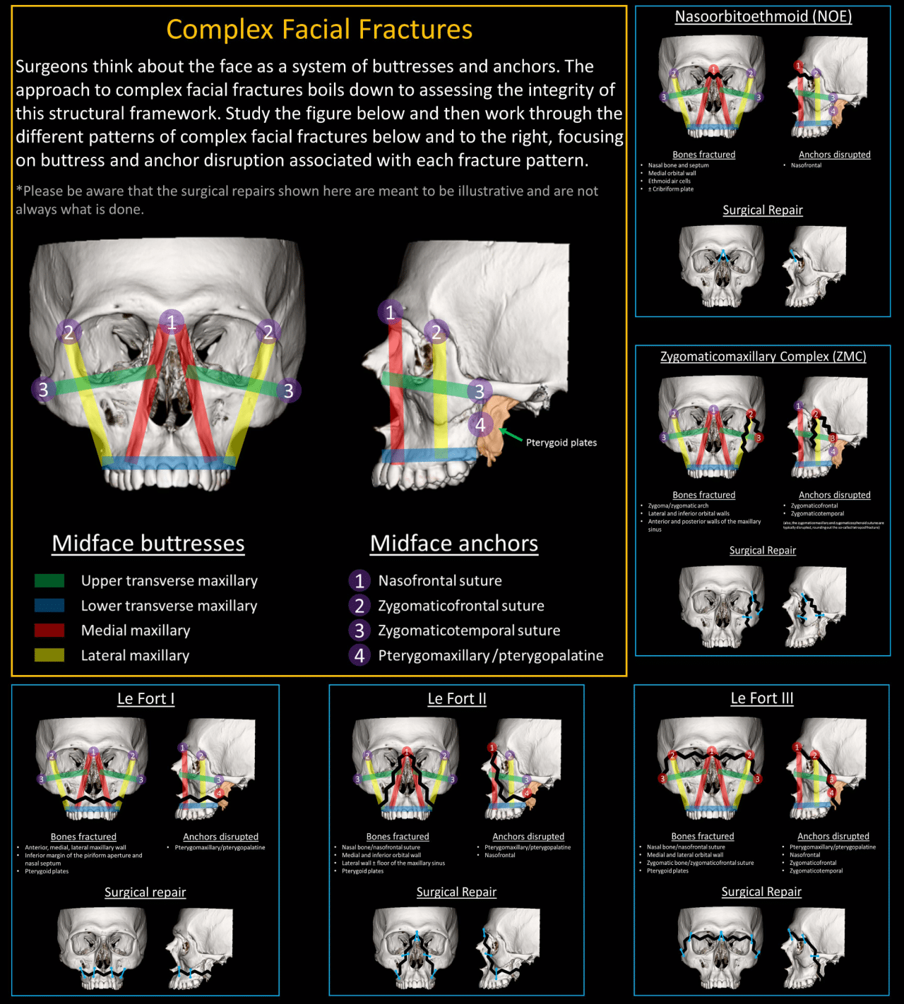 Complex Facial Fractures