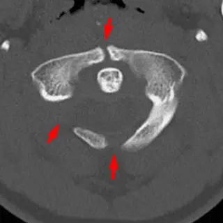 Congenital Anomalies of C1