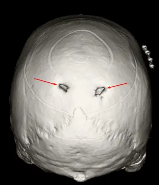 Enlarged Parietal Foramina