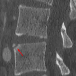 Limbus Vertebra