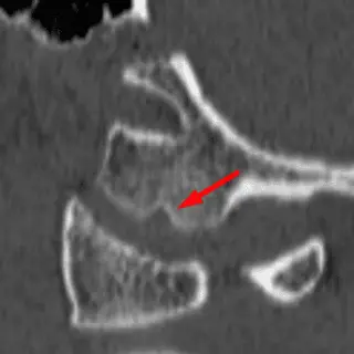 Medial Occipital Condyle "Notch"