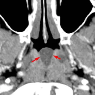 Tornwaldt Cyst