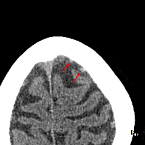 cortical-vein-axial